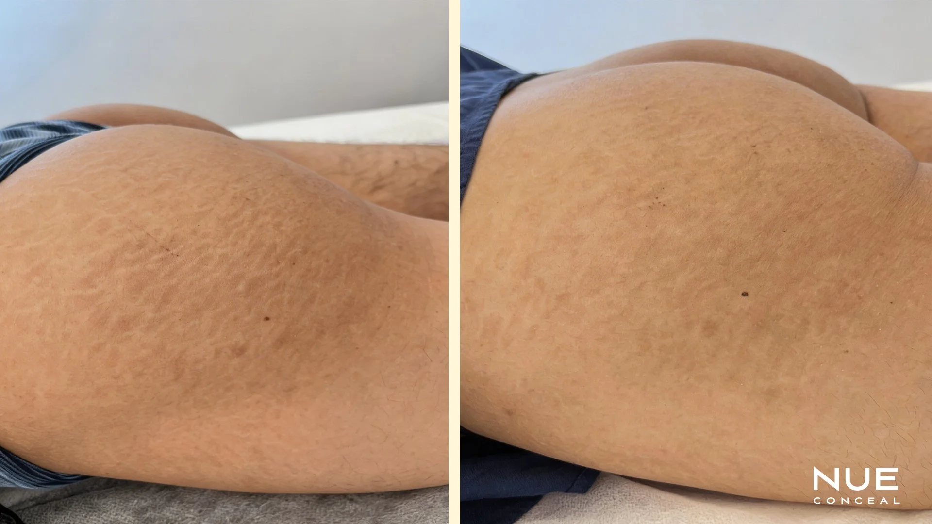 Buttocks stretch marks camouflage treatment before and after