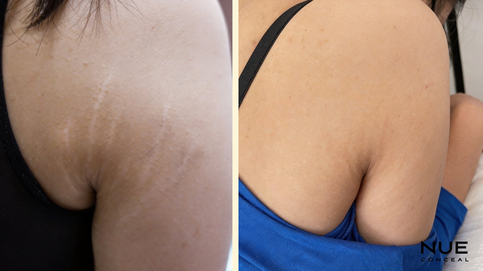 Shoulder Stretch Marks camouflage before and after