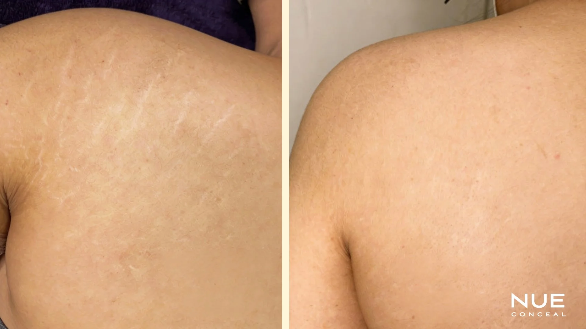 Shoulder stretch marks before and after camouflage tattoo session