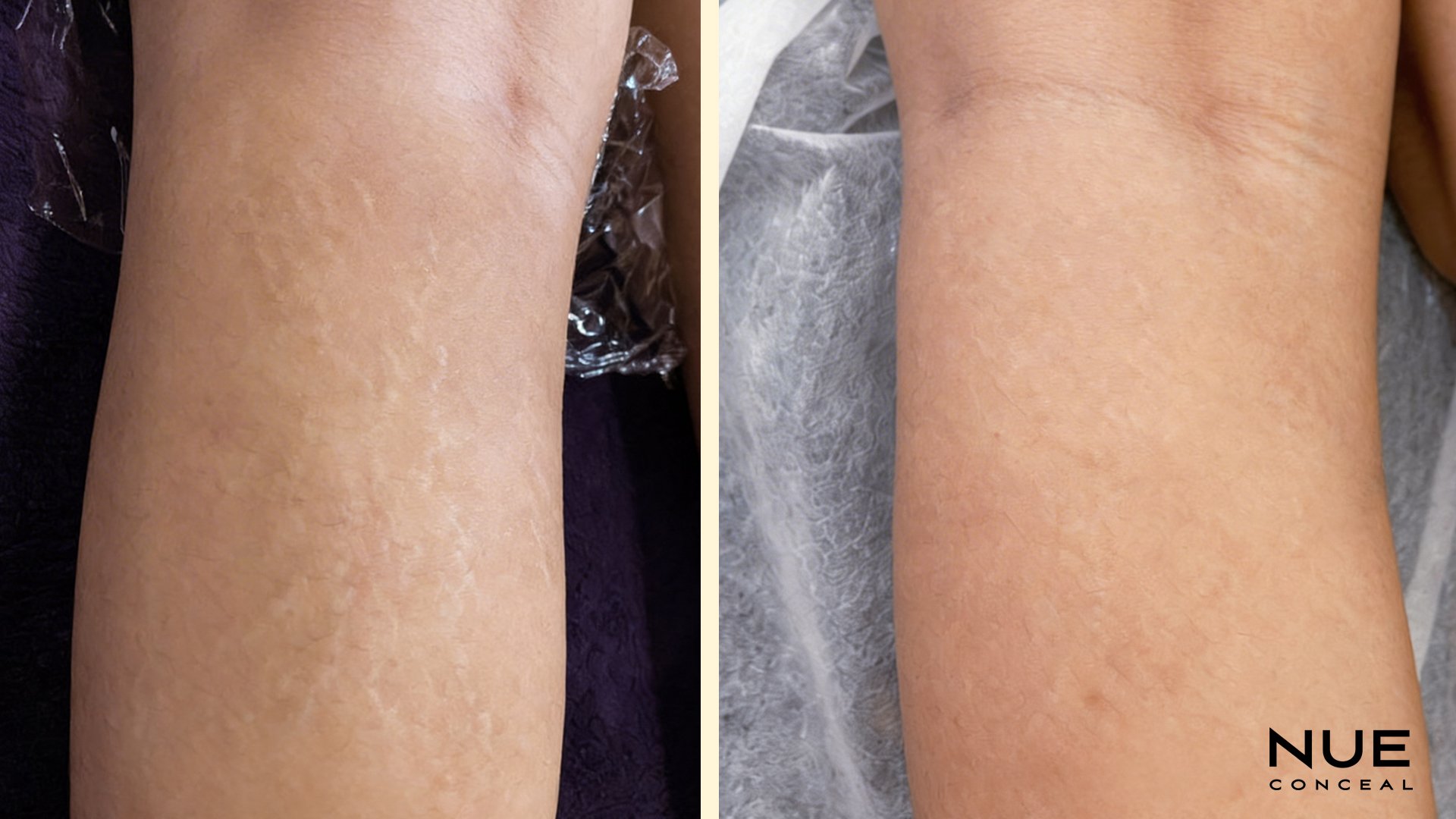 Back of Leg Stretch Marks camouflage procedure