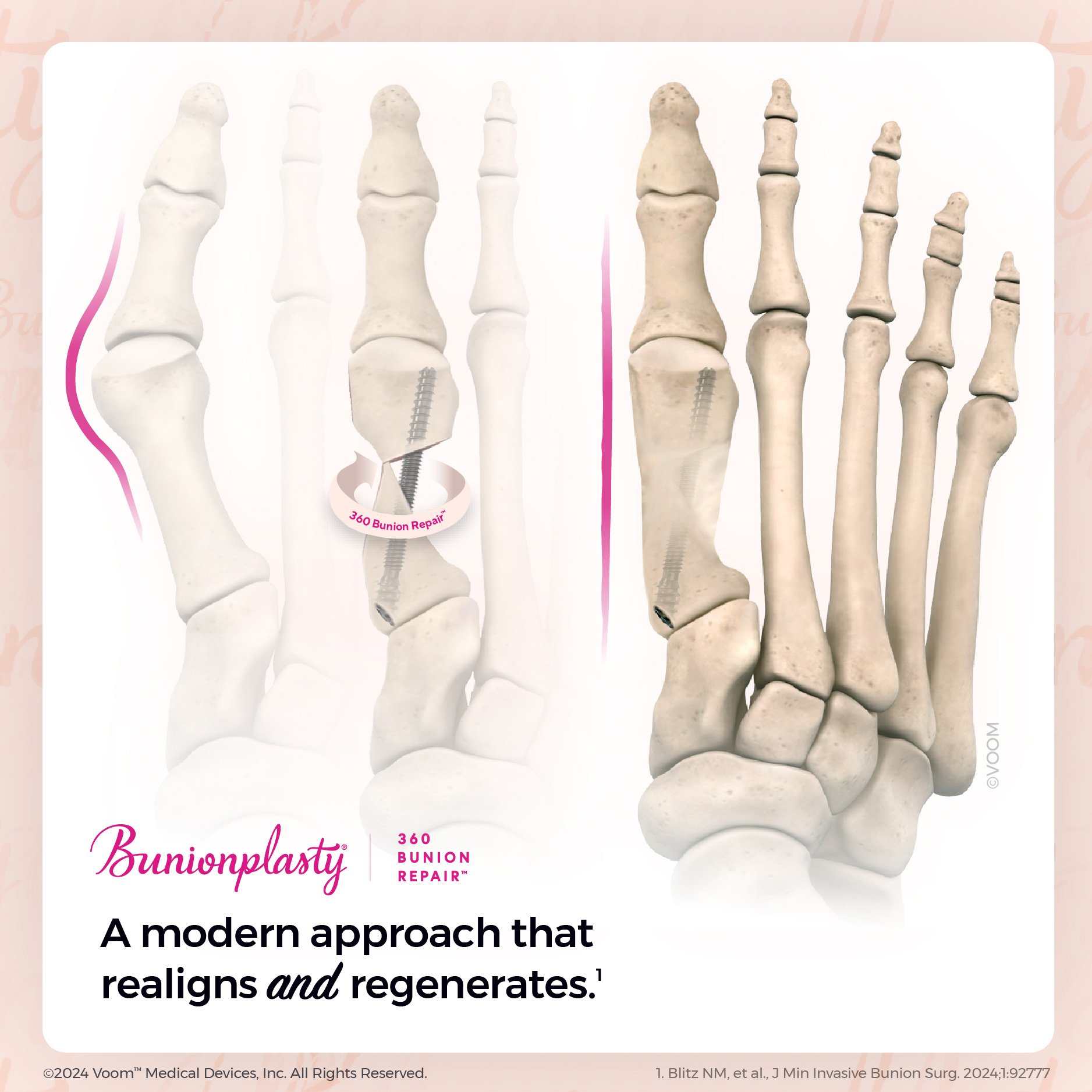 Diagram of a foot showing bone repair with 360 Bunion Repair procedure, illustrating bone realignment and regeneration.