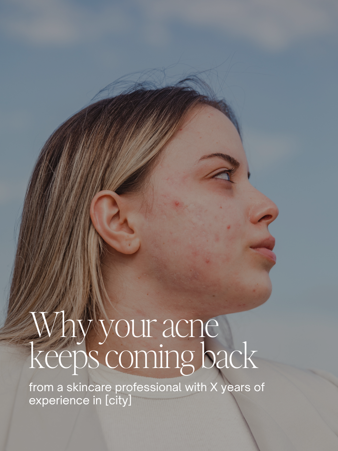 Why your acne  keeps coming back