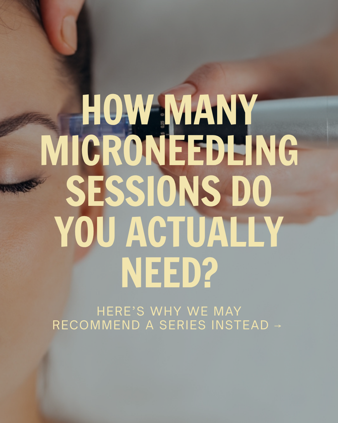 How Many Microneedling Sessions Do You Actually Need?
