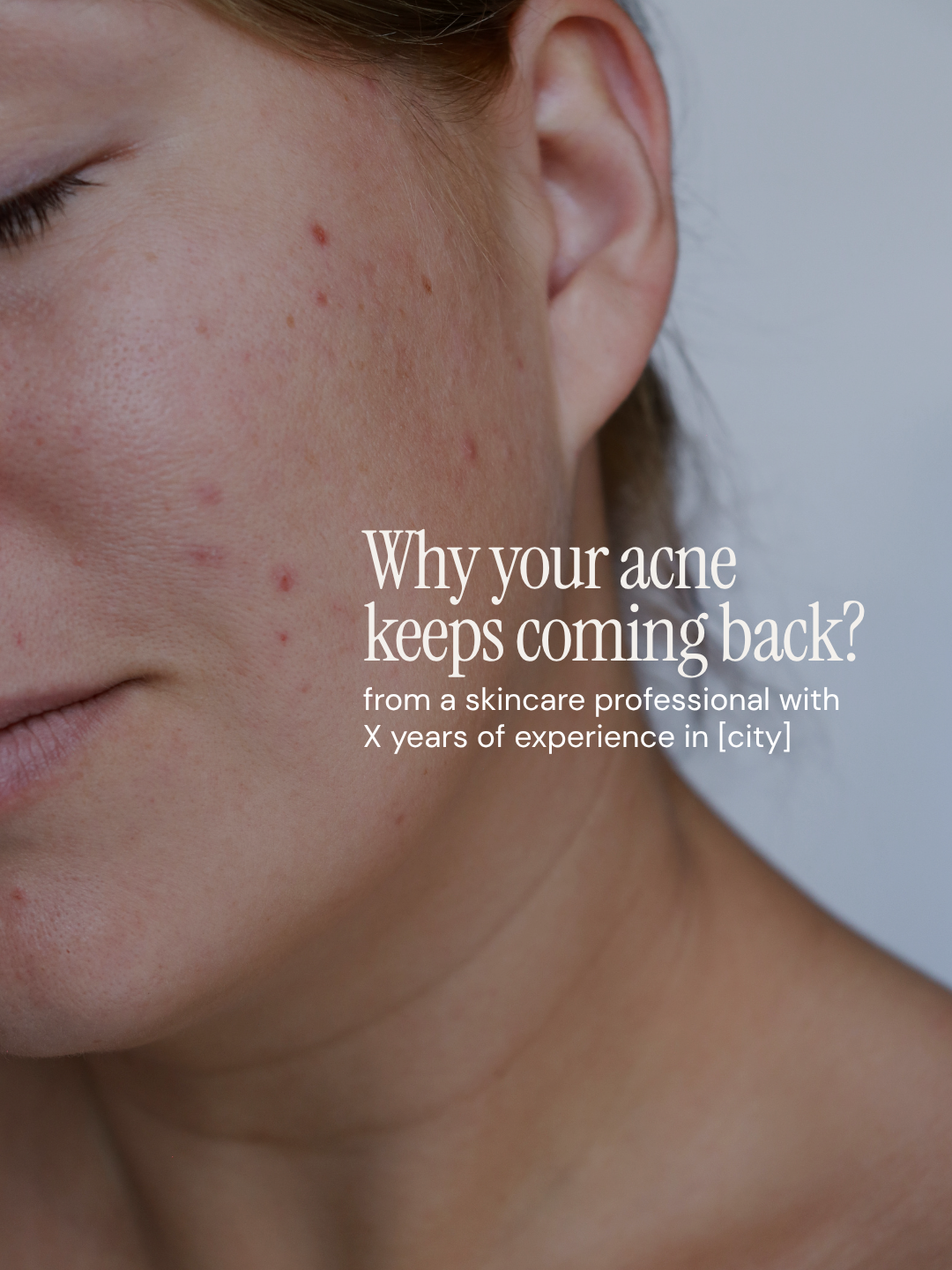Why your acne  keeps coming back