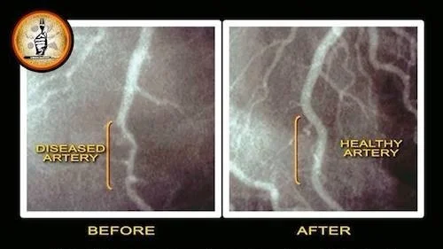 Artery 2.jpg