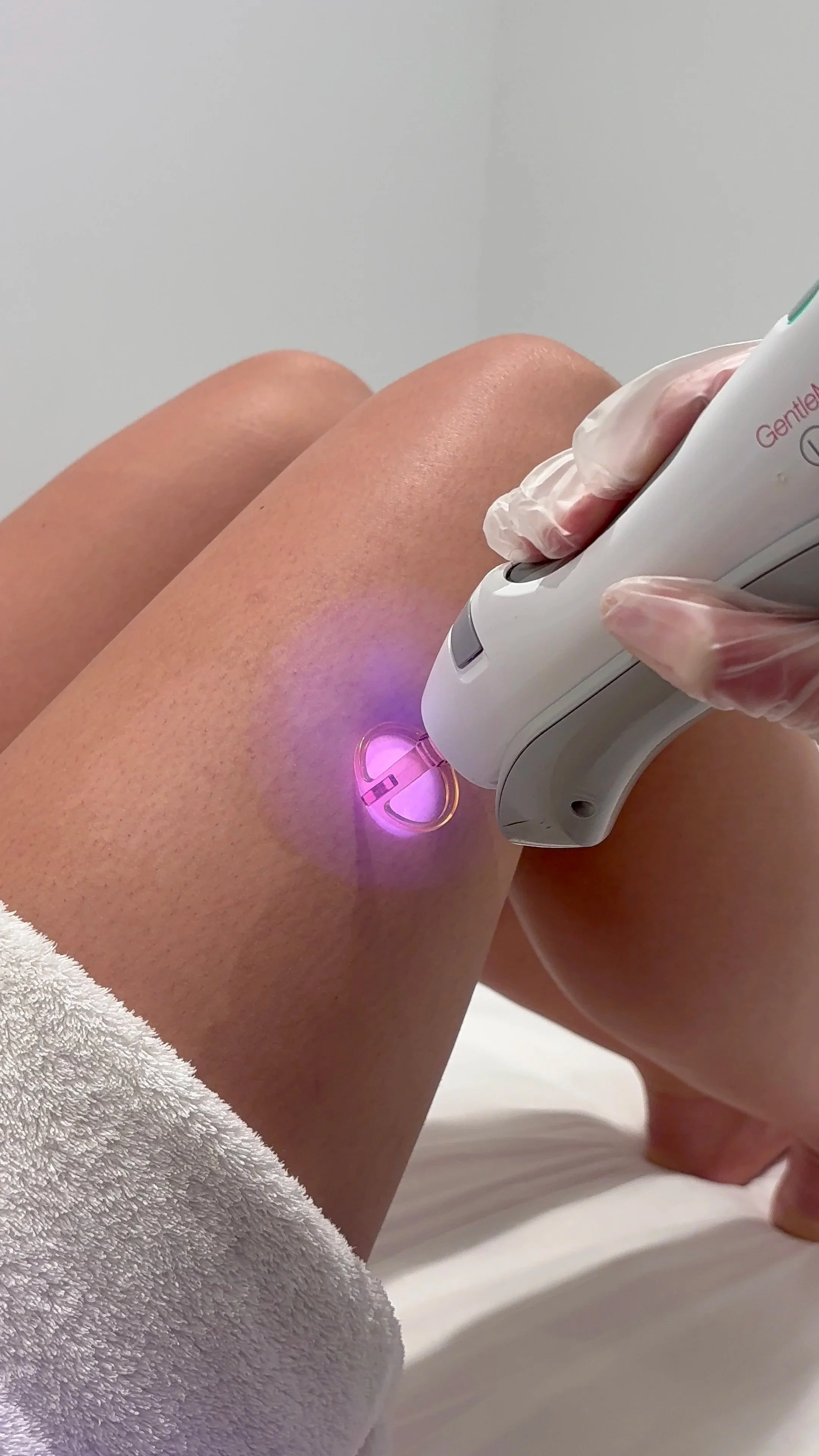 Someone receiving a cosmetic or medical treatment on their thigh using a handheld device emitting a purple light, while wearing gloves.