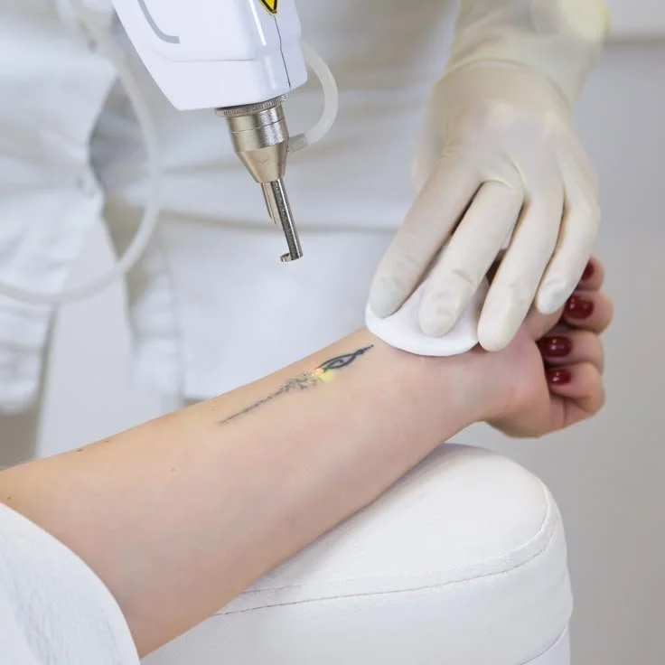 A person getting a laser tattoo removal on their forearm, with the technician wearing gloves using a handheld device.
