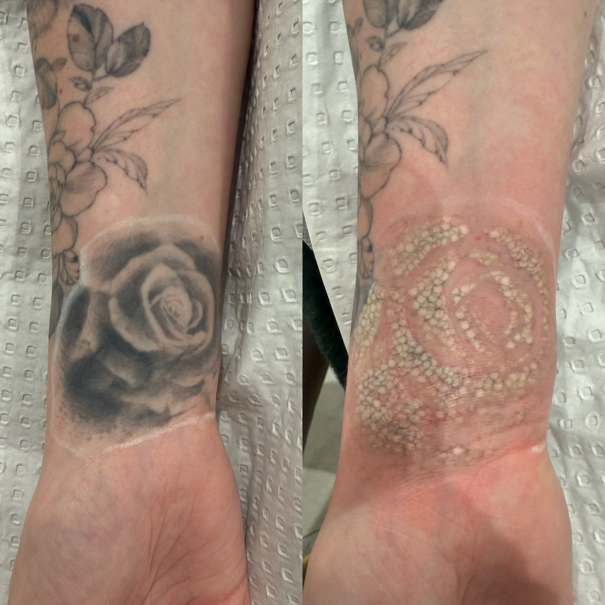 Tattooed forearm showing a black and gray rose with leaves and a bud, with the skin around the tattoo covered in healing dots from a recent tattoo removal or lightening treatment.