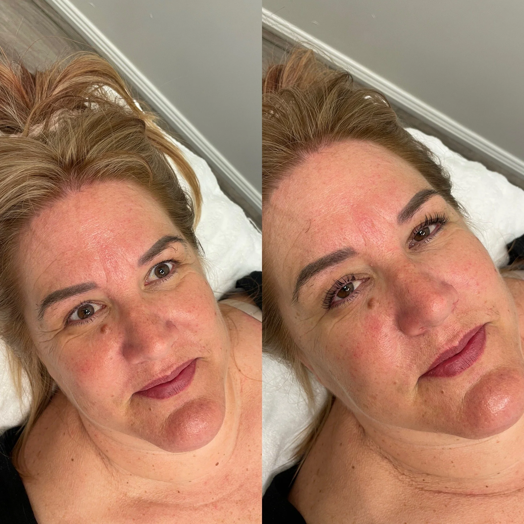 Close-up of a woman lying down with visible facial redness and skin imperfections, showing before and after cosmetic treatment results.