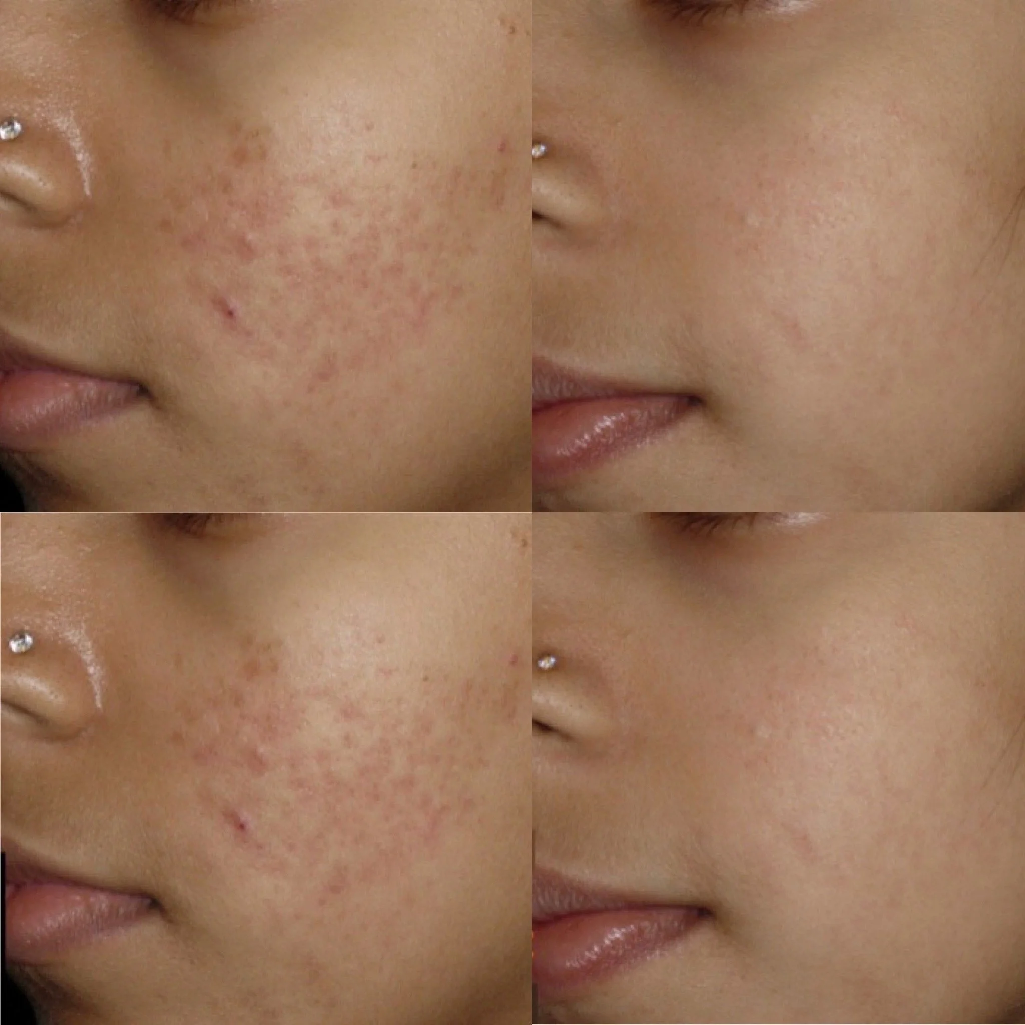 A collage of four close-up photos showing a woman's cheek before and after skincare treatment, illustrating improved skin clarity and reduced acne scars.