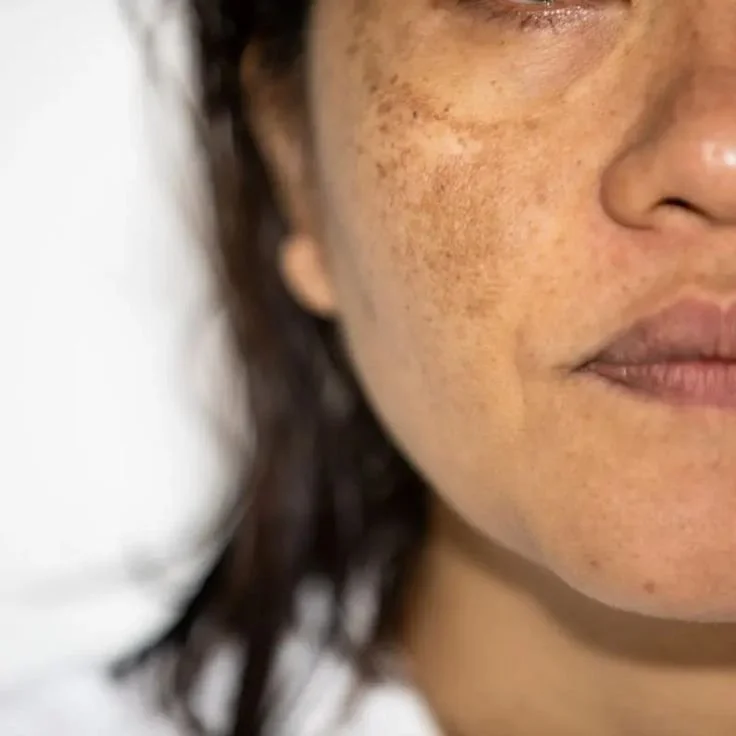 Close-up of a woman's face showing freckles and skin texture near her nose and lips, with part of her eye and cheek visible.