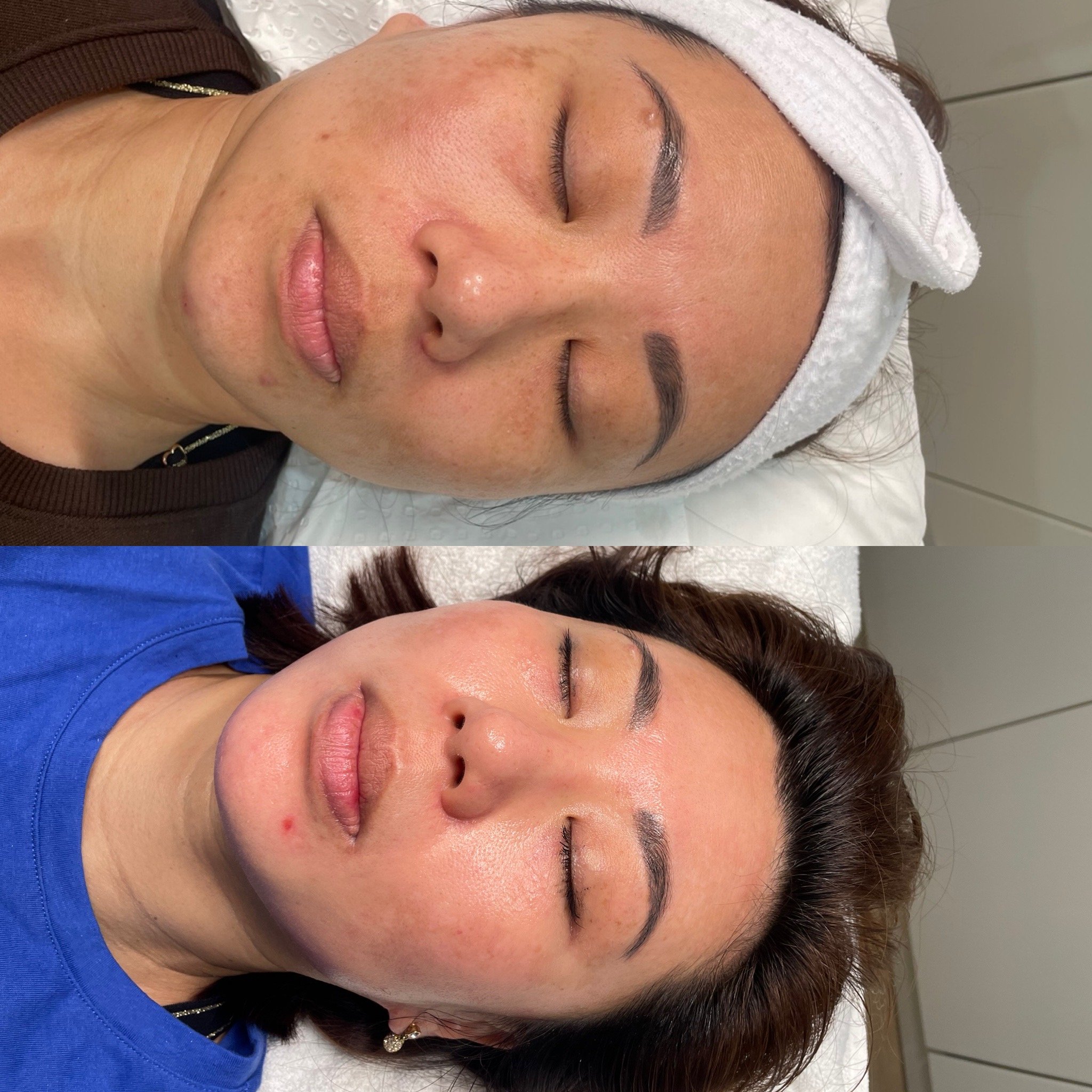 A woman with closed eyes lying down before and after a facial treatment, showing improved skin smoothness and glow.
