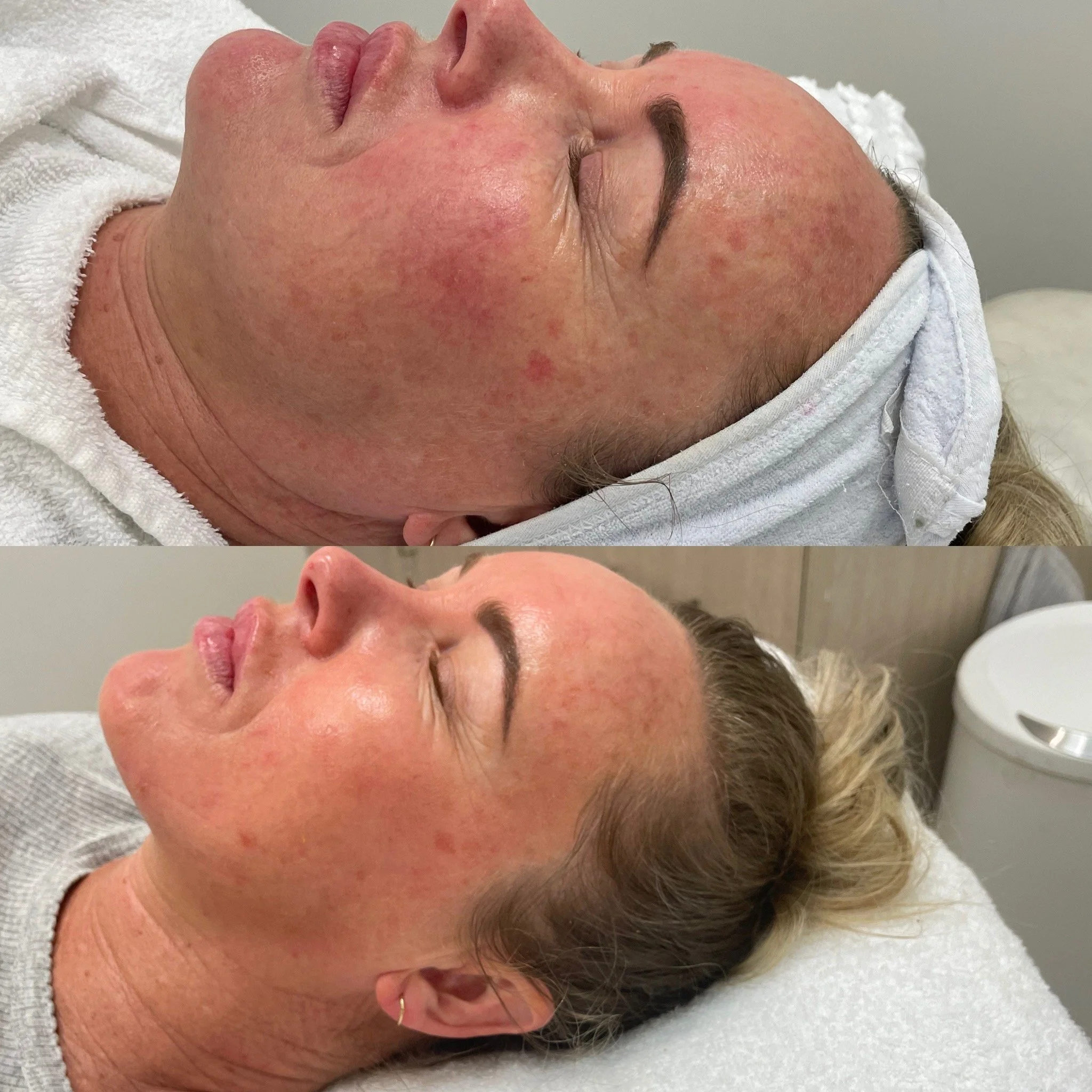 Before and after images of a woman with facial redness and skin irritation, showing significant improvement in skin appearance after treatment.