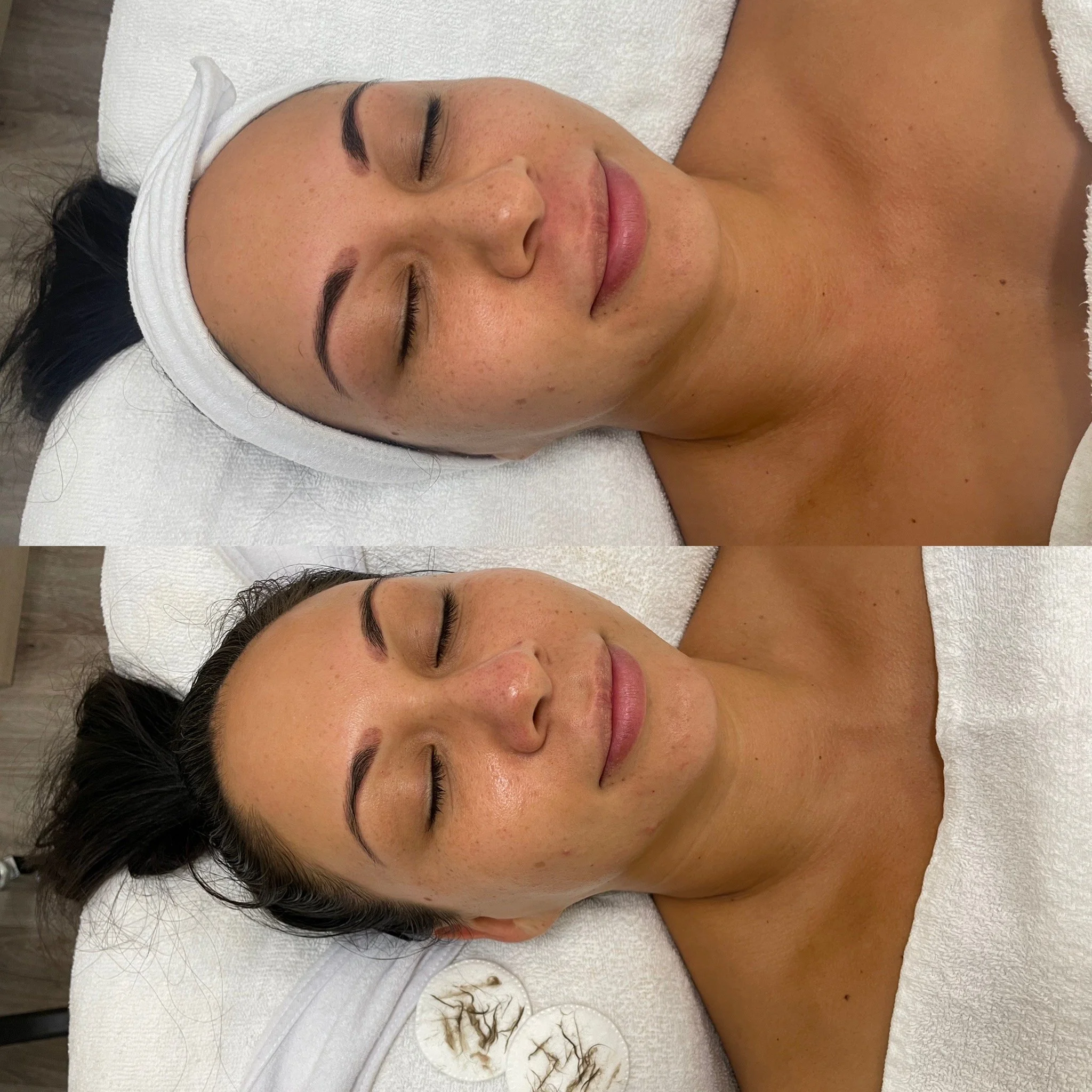 Before and after images of a woman receiving a facial treatment, showing improved skin texture and reduced redness.