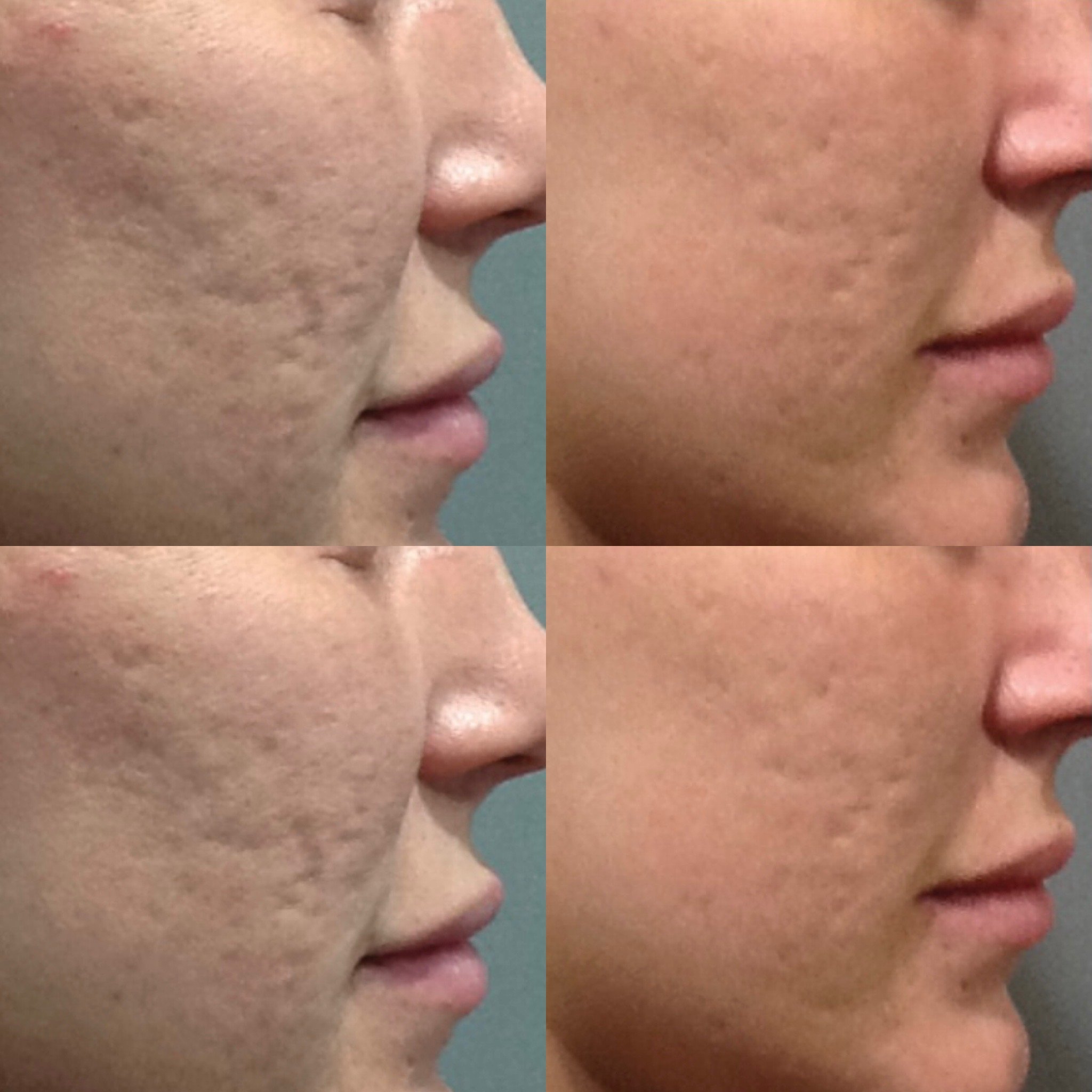 Comparison of skin before and after treatment showing reduced acne scars and improved skin texture.