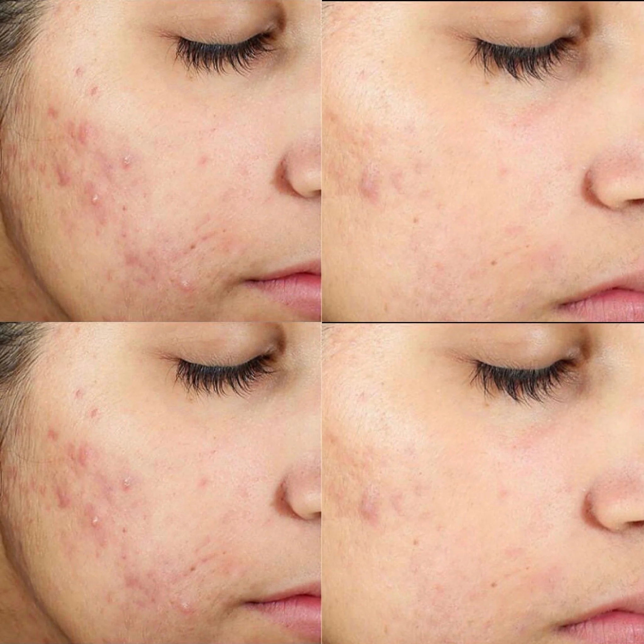 A collage of four close-up images showing the lower face of a person with and without acne, demonstrating skin clearing or treatment effects.