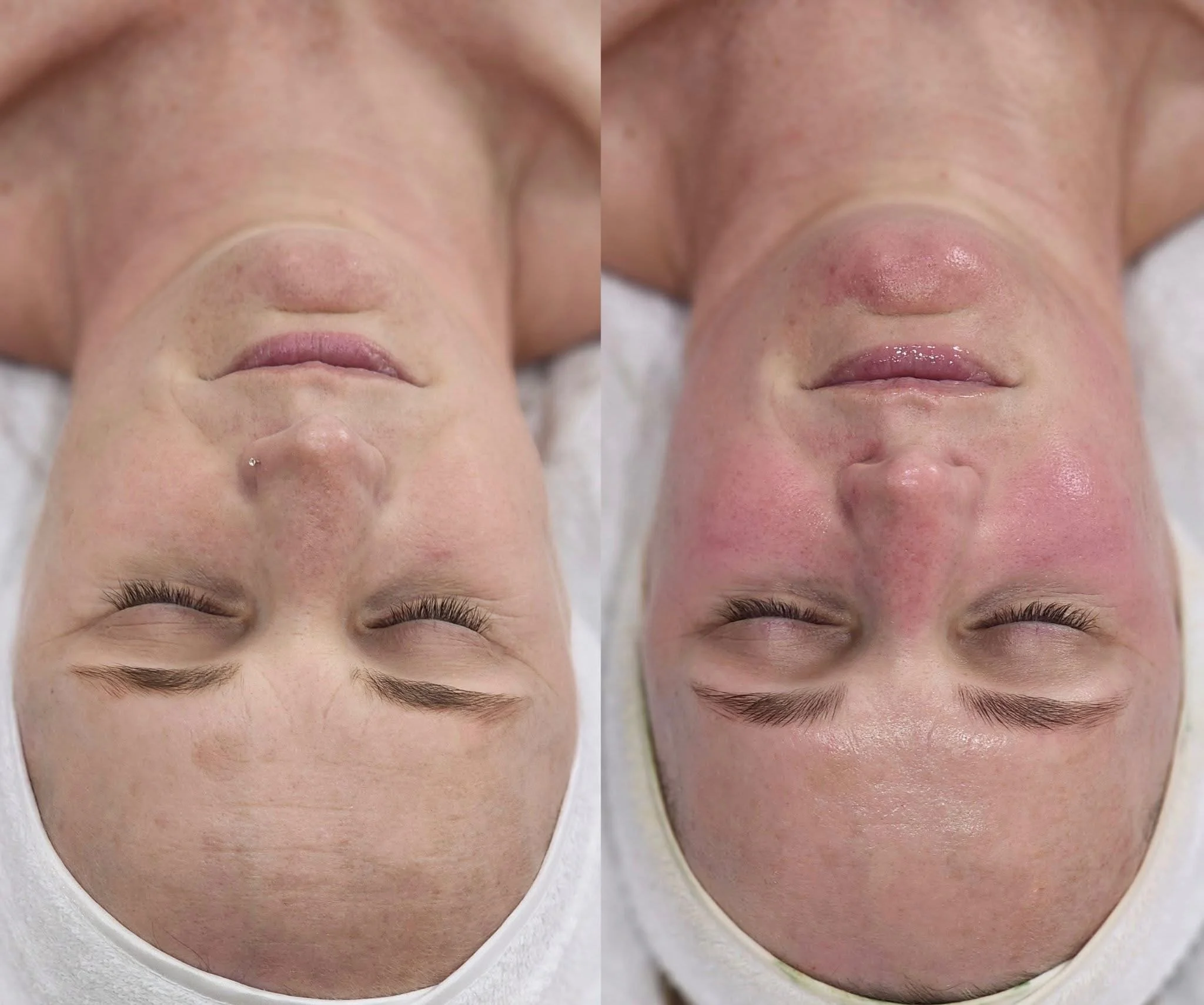 Side-by-side comparison of a woman's face before and after a facial treatment, showing skin improvement and redness reduction.