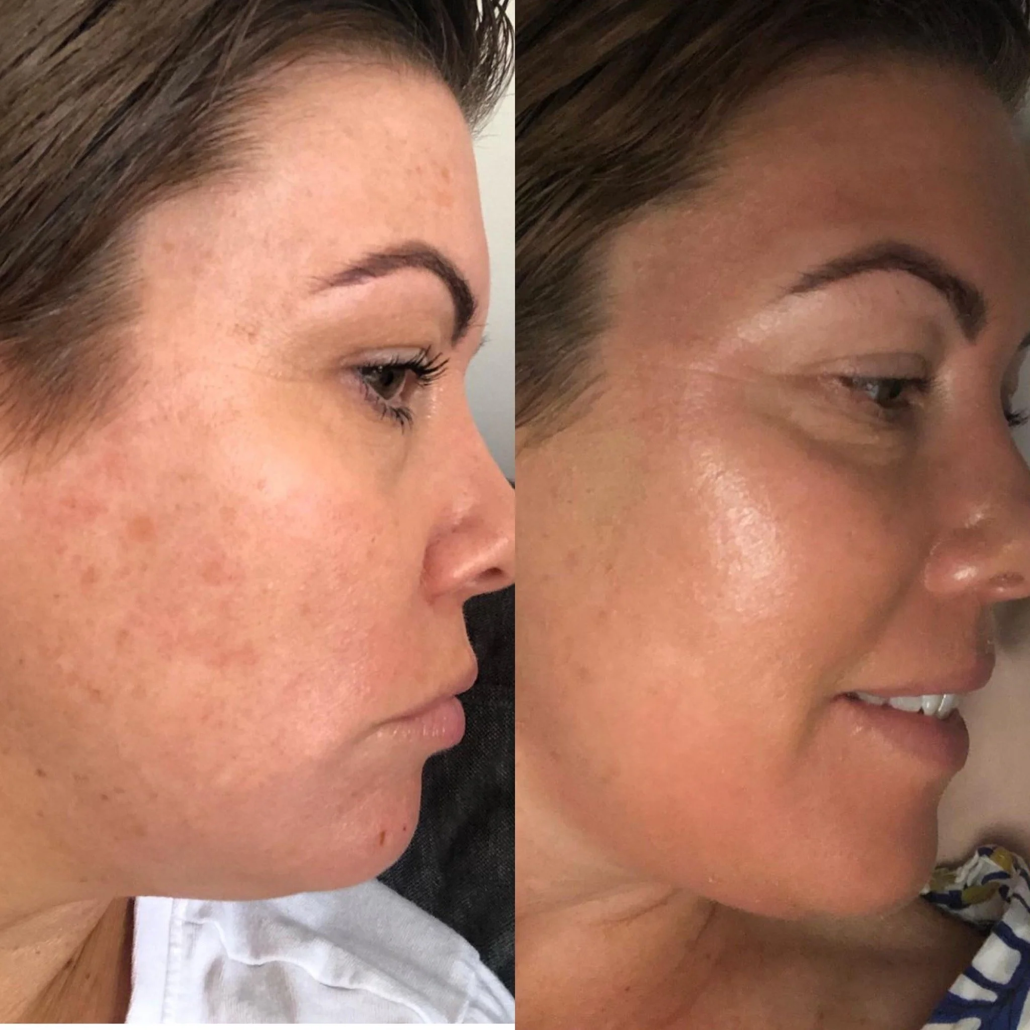 Side-by-side comparison of a woman's face showing clear skin before and after skincare treatment, with the left side displaying acne scars and uneven skin texture, and the right side showing smooth, glowing skin.