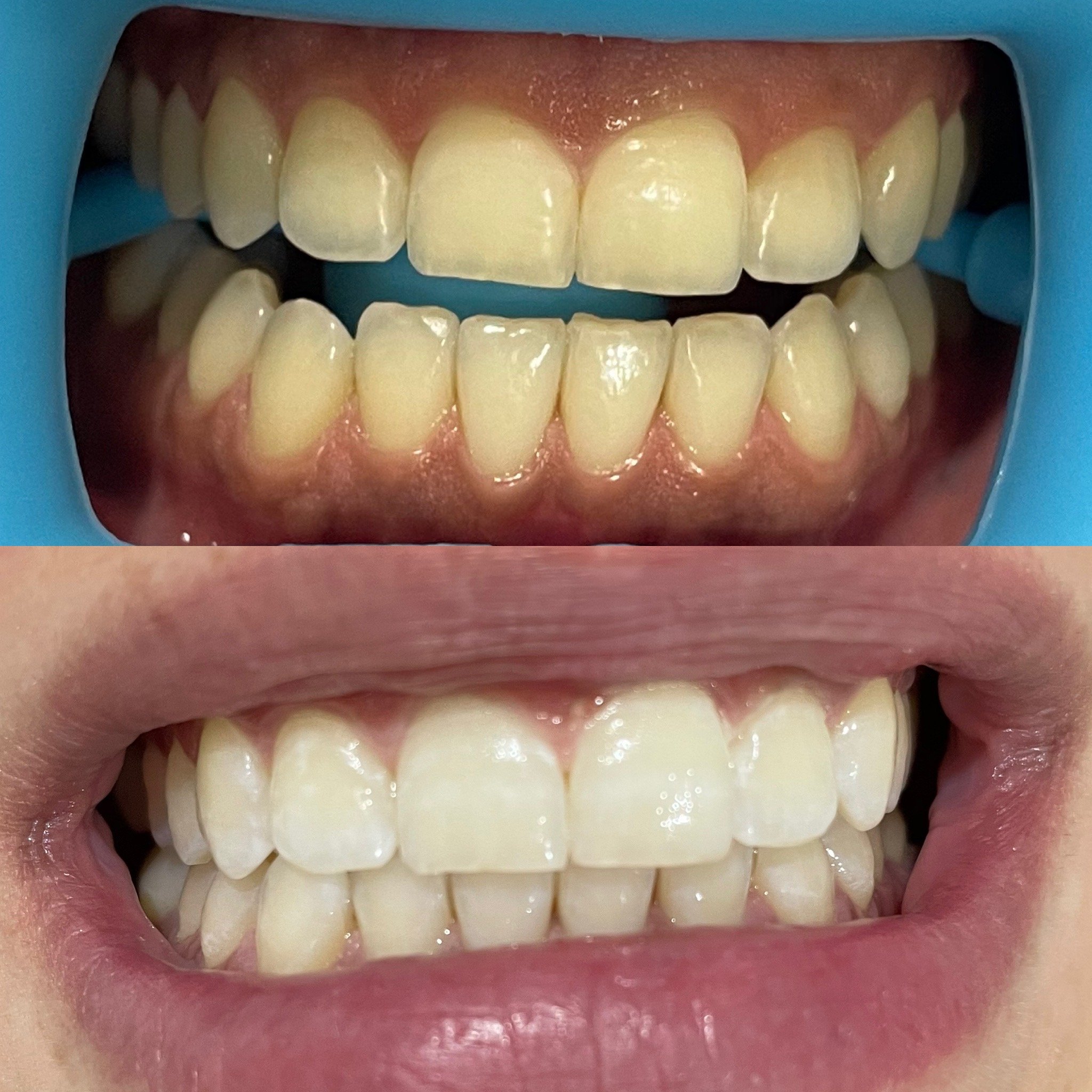 Comparison of teeth before and after dental correction, showing improved alignment and appearance.