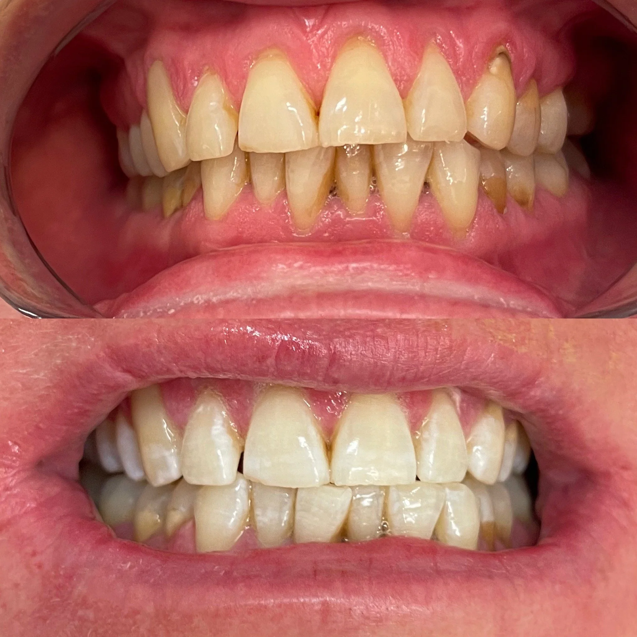 Close-up of a person's teeth showing on the top and bottom, with some misalignment and discoloration.