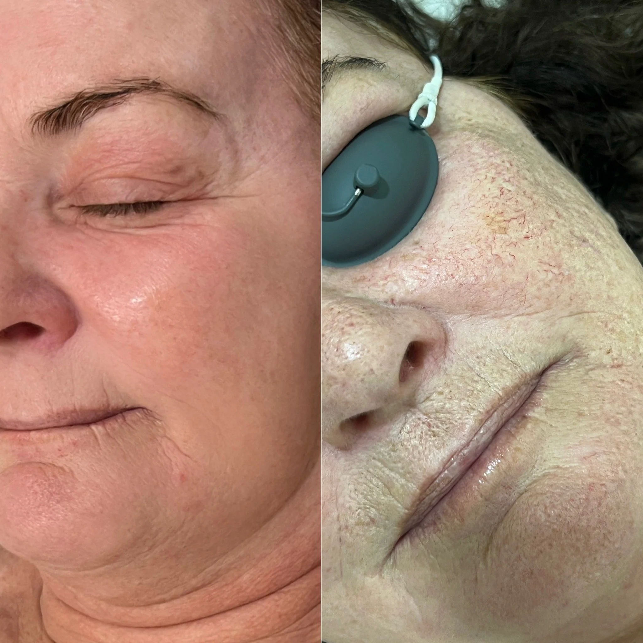 Comparison of a person's face before and after skincare treatment, showing improved skin texture on the left and dull, dry skin with visible cracks and an eye mask on the right.