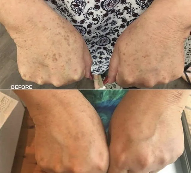 A side-by-side comparison of hands in a clenched fist position, showing significant improvement in skin appearance after treatment or skincare routine.