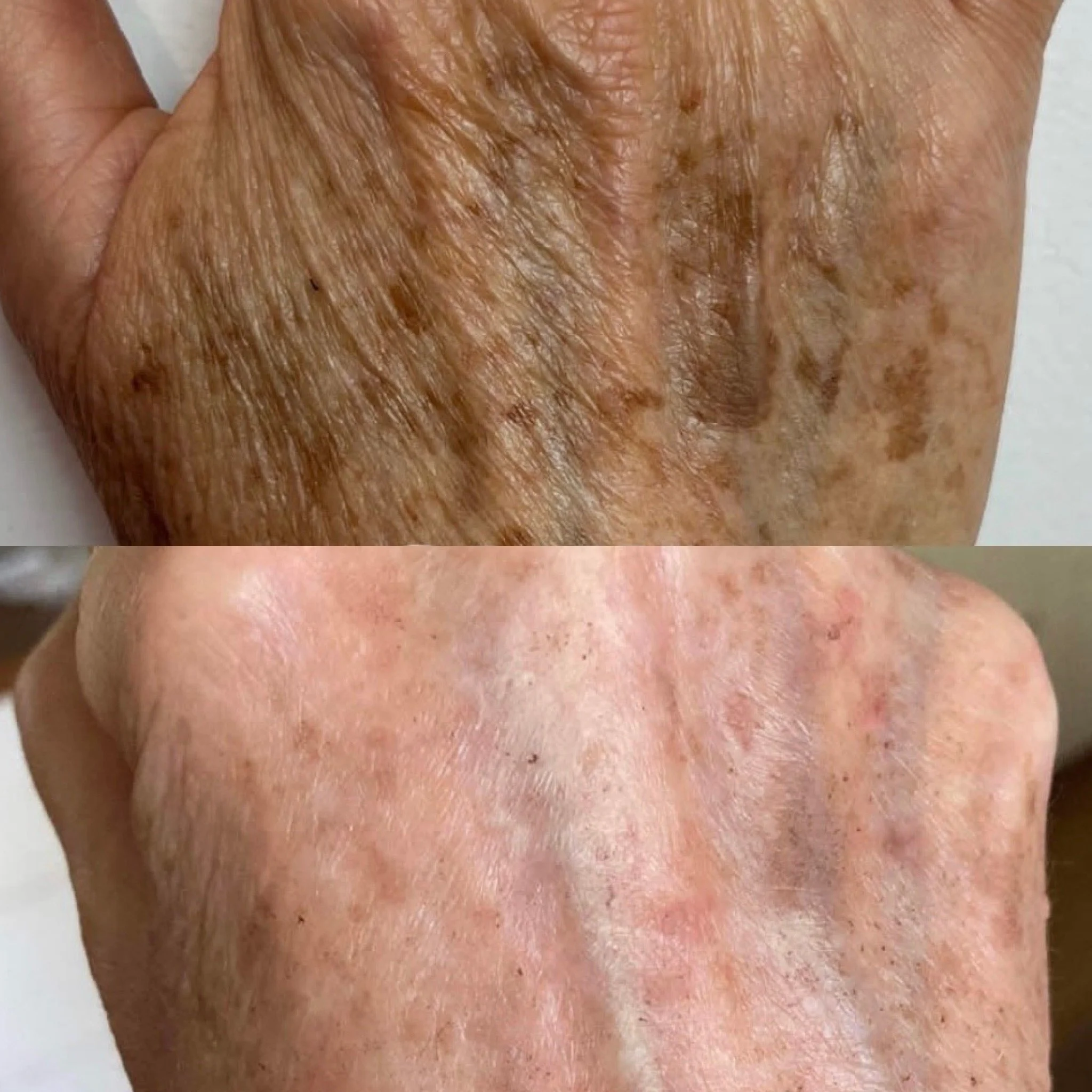 Close-up comparison of skin showing significant sun damage and wrinkles in the upper image, and healthier, smoother skin in the lower image.