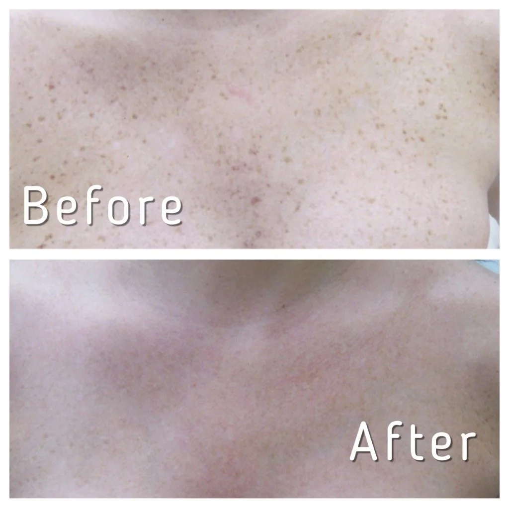 Close-up of skin before and after a cosmetic treatment, showing reduced redness and smoother appearance.