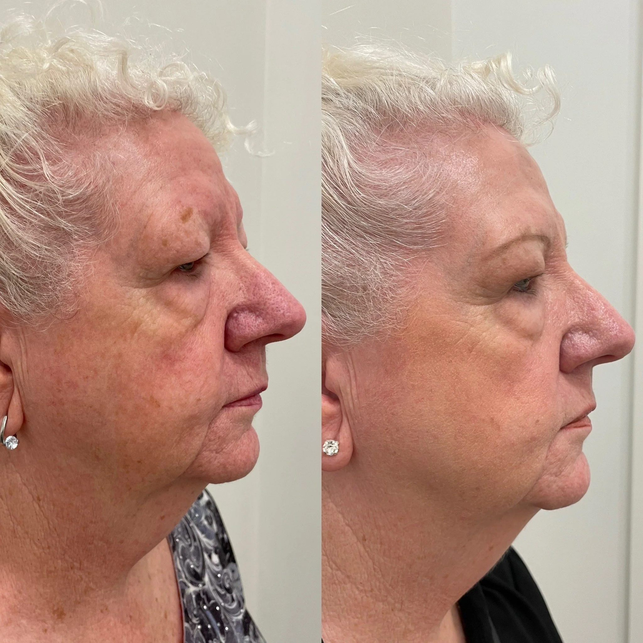 Comparison of a woman's face before and after skincare treatment, showing reduced redness, age spots, and improved skin texture.