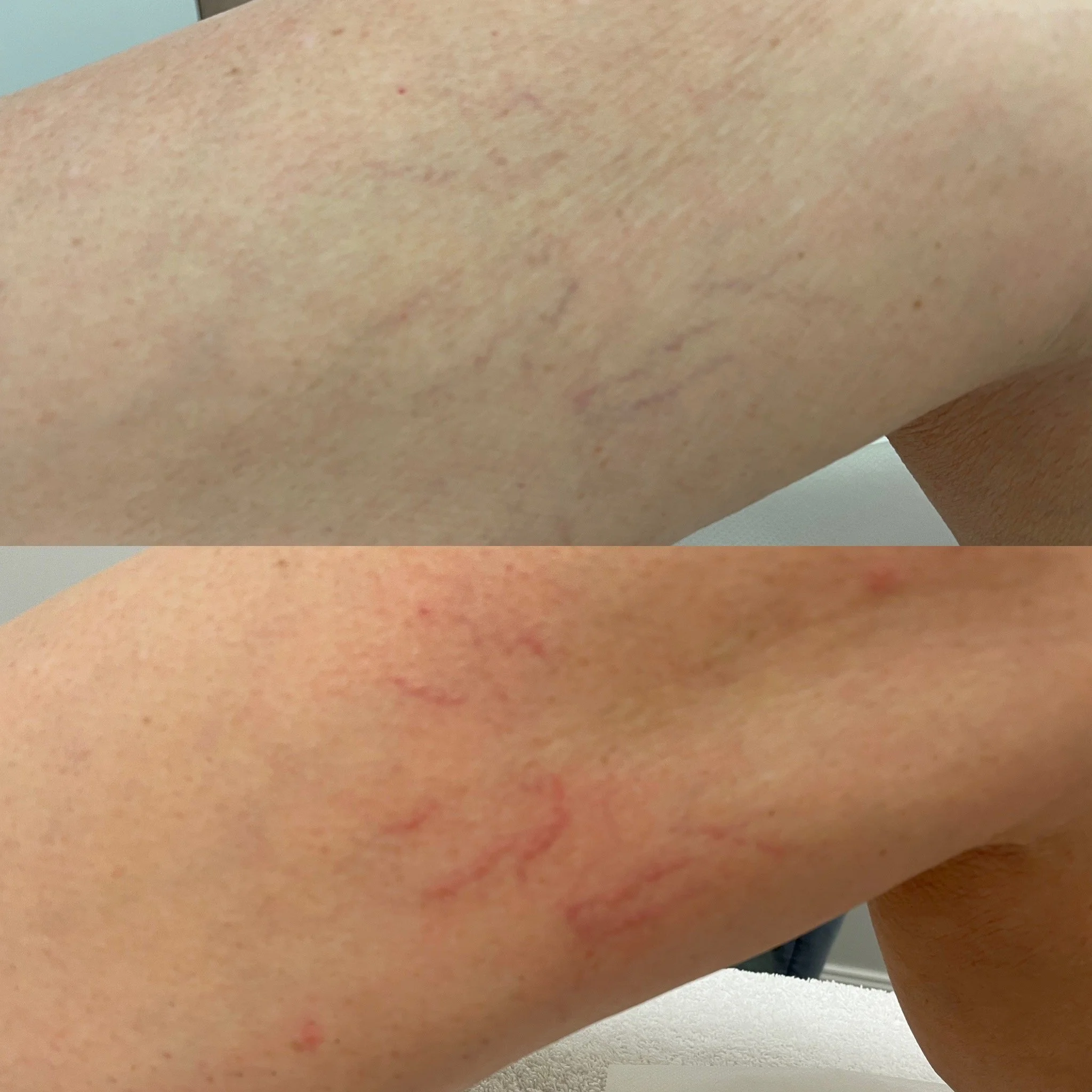 Close-up of a person's underarm showing before and after treatment for stretch marks, with the top image showing more visible stretch marks and the bottom image showing fewer and less prominent stretch marks.