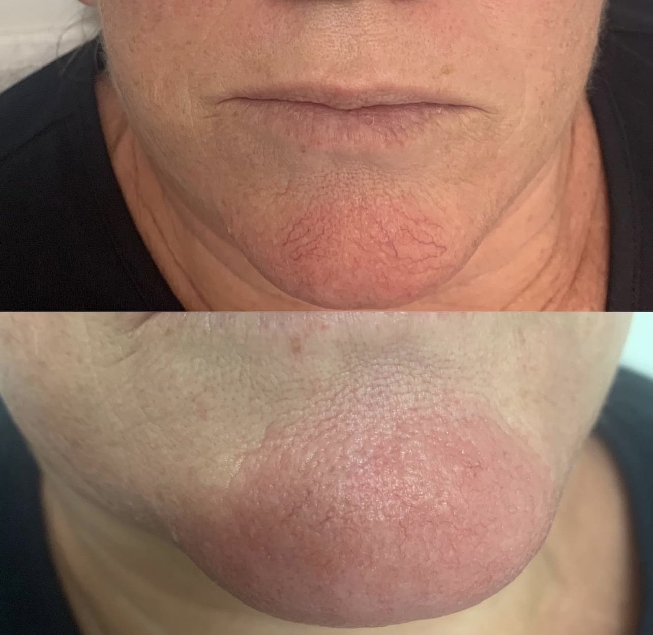Close-up comparison of a person's tongue before and after treatment, showing reduction in redness and dryness.