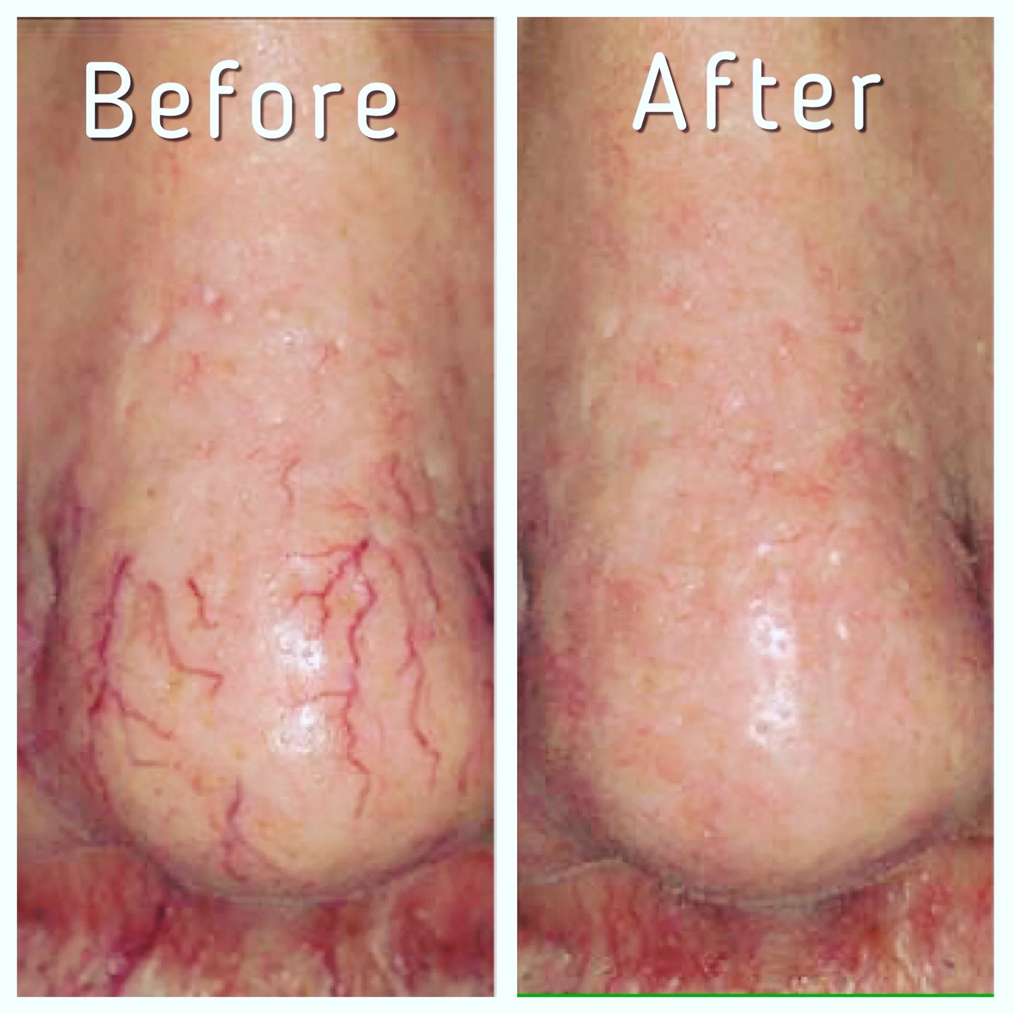 Comparison of a nose before and after treatment, showing reduced redness and visible blood vessels after treatment.