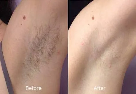 Comparison of underarm hair removal, showing the before and after results with less hair in the after image.