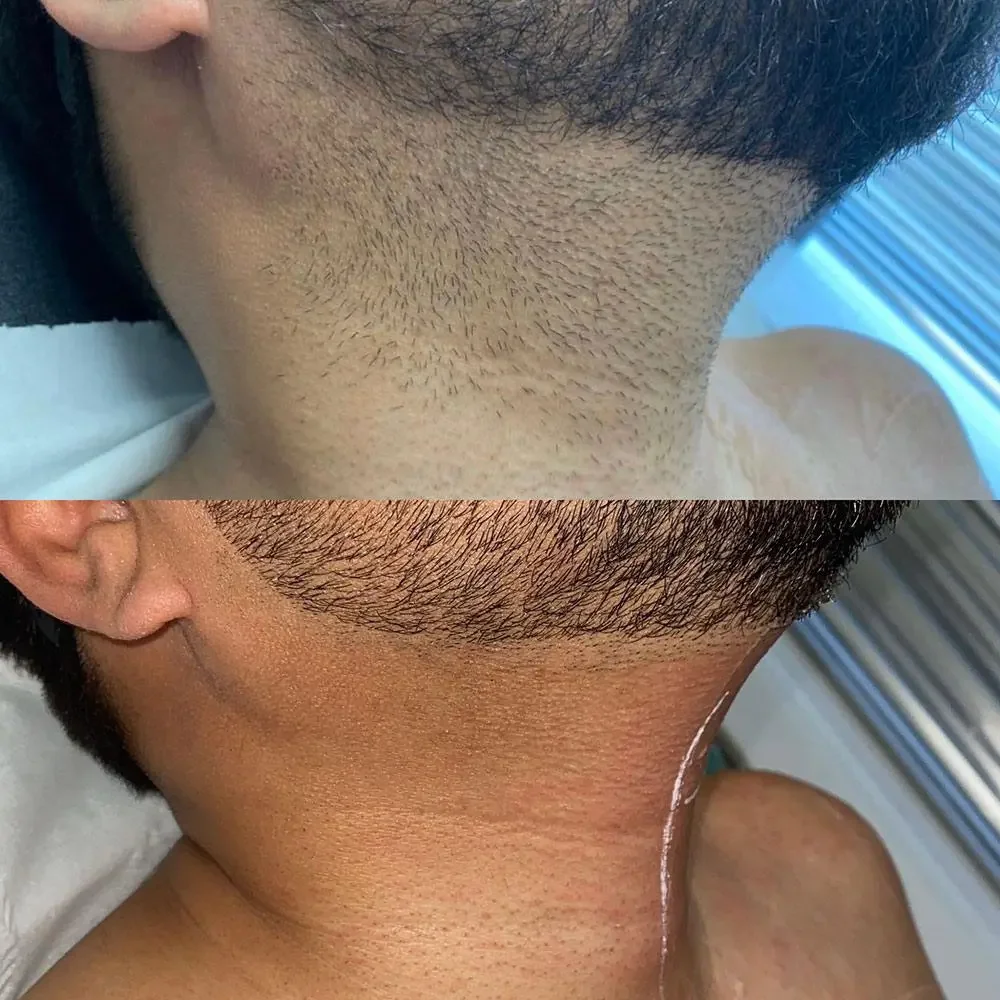 Comparison of a person's neck before and after a cosmetic procedure to improve skin appearance, showing smoother skin and improved texture in the after image.