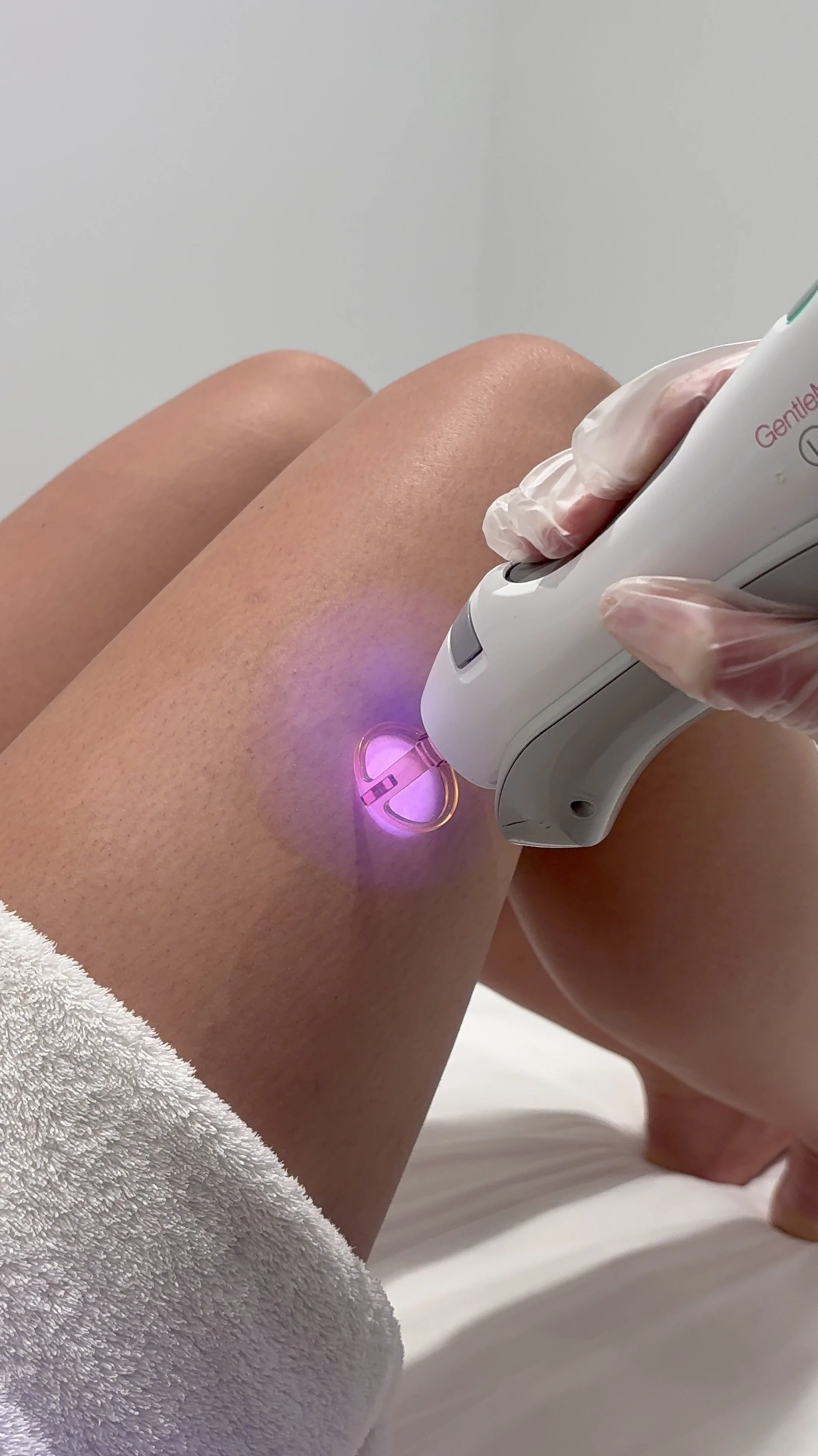 Close-up of a person receiving a laser hair removal treatment on their legs, with a technician wearing gloves holding the device.