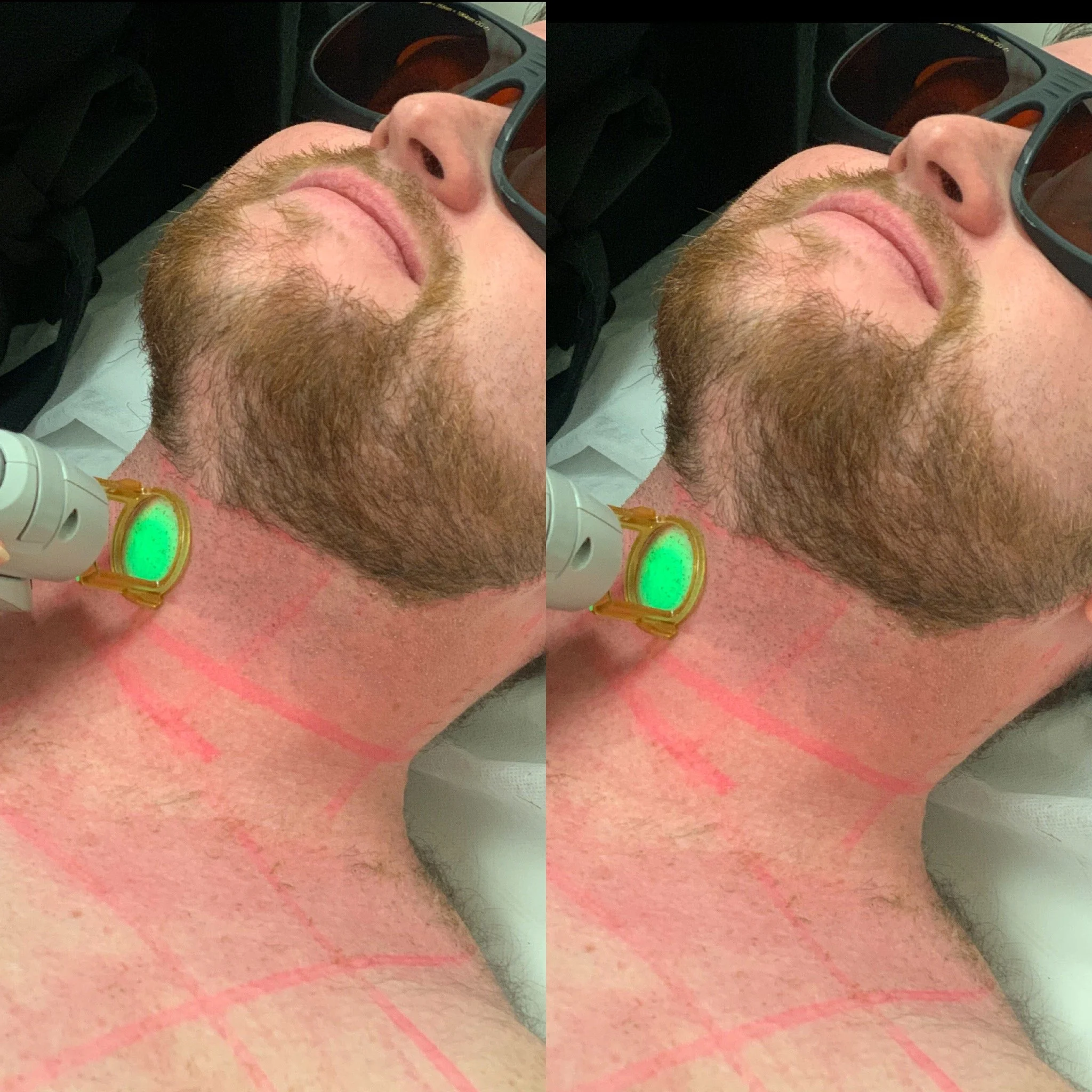 A man lying in a medical setting with markings on his neck and chest, receiving laser hair removal treatment on his neck.