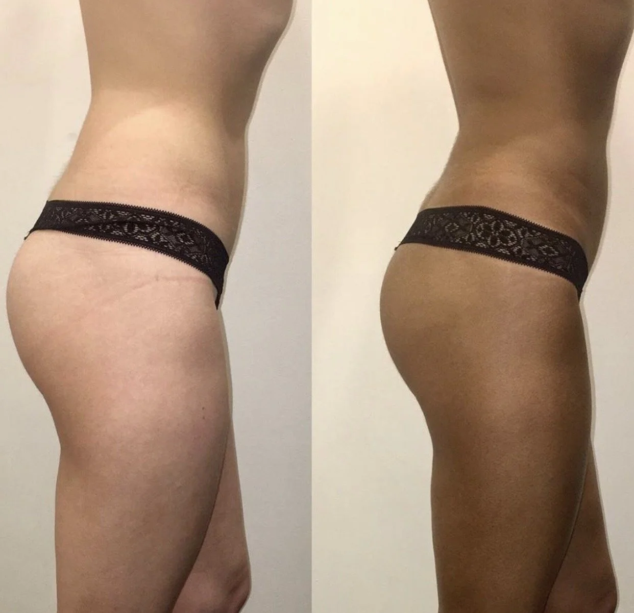 Side-by-side comparison of a woman's body before and after a fitness transformation, showing toned and sculpted buttocks and thighs.