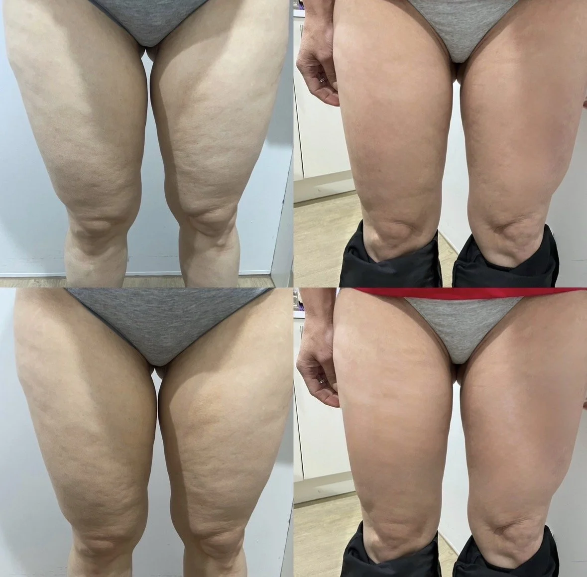 Comparison of before and after images showing the improvement of skin texture on person’s thighs. Top left and bottom left images show skin with cellulite or stretch marks before treatment, while top right and bottom right images show smoother skin a