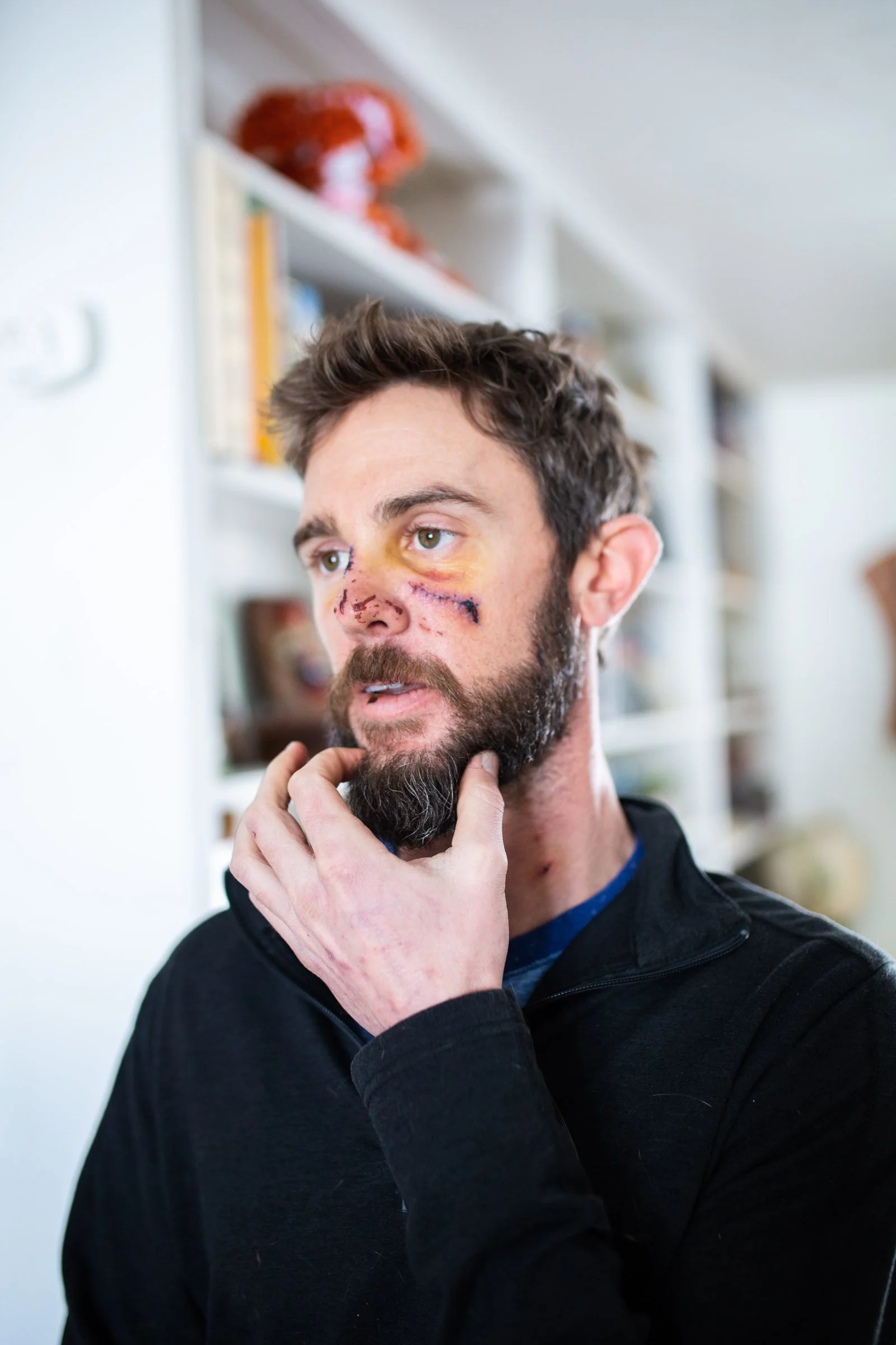 Man with a beard and brown hair looking thoughtful, with black eyes and bruises on his face. He was recently in a fight with a mountain lion.