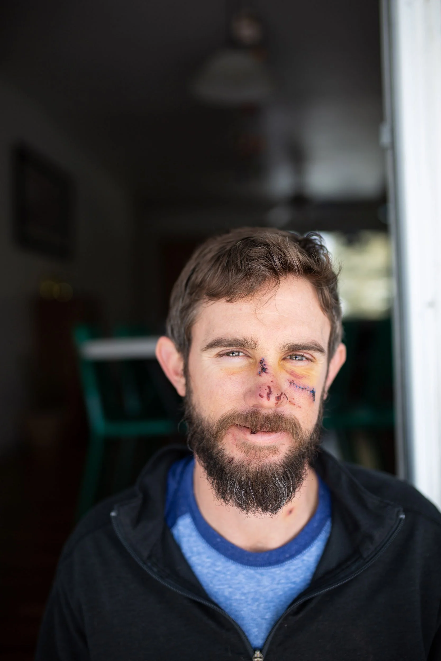 A man with a beard and short brown hair smiling, with visible facial scars and bruises on his nose and cheeks.