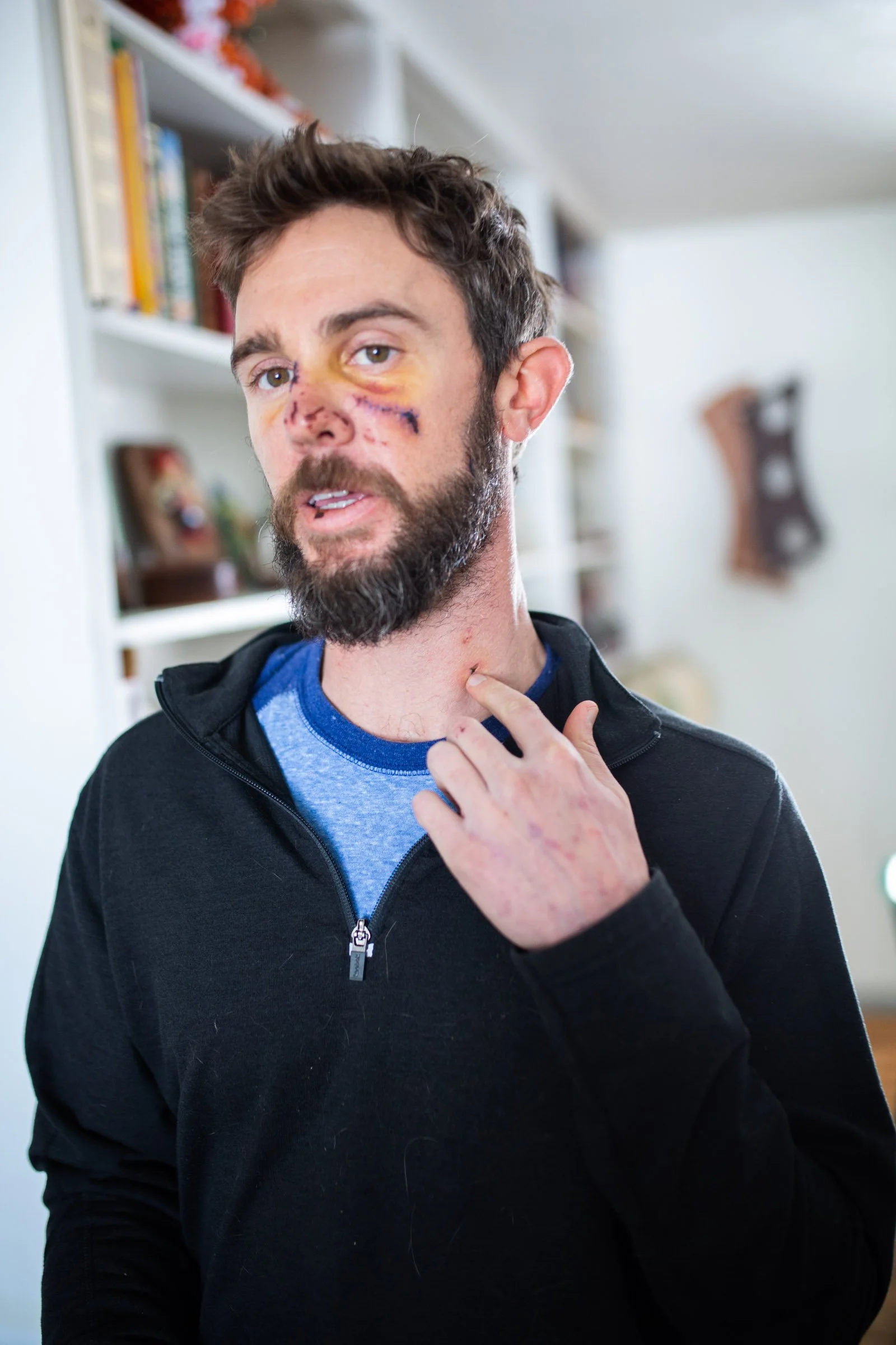 A man with a beard and brown hair has bruises and cuts on his face, and is touching his neck with his right hand. He is wearing a black zip-up hoodie over a blue T-shirt. T