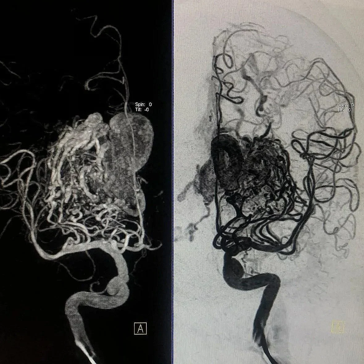 Malformación arteriovenosa cerebral con aferencias de arterias lenticuloestriadas