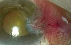 Close-up of an eye showing redness and irritation in the sclera and conjunctiva caused by an advanced pterygium prior to surgery