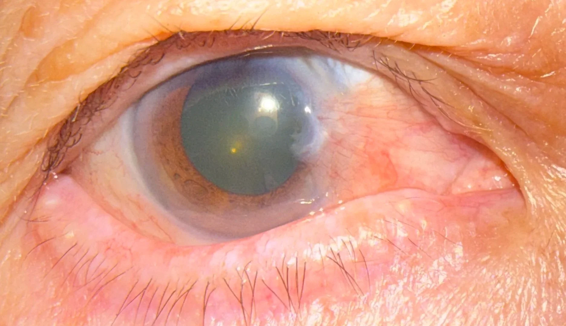 Close-up of a human eye with a cataract and pterygium, showing the cloudy lens and surrounding red inflamed growth.