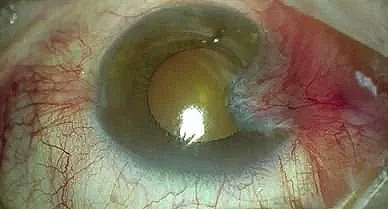 Eye showing redness and irritation in the sclera and conjunctiva caused by an advanced pterygium prior to surgery