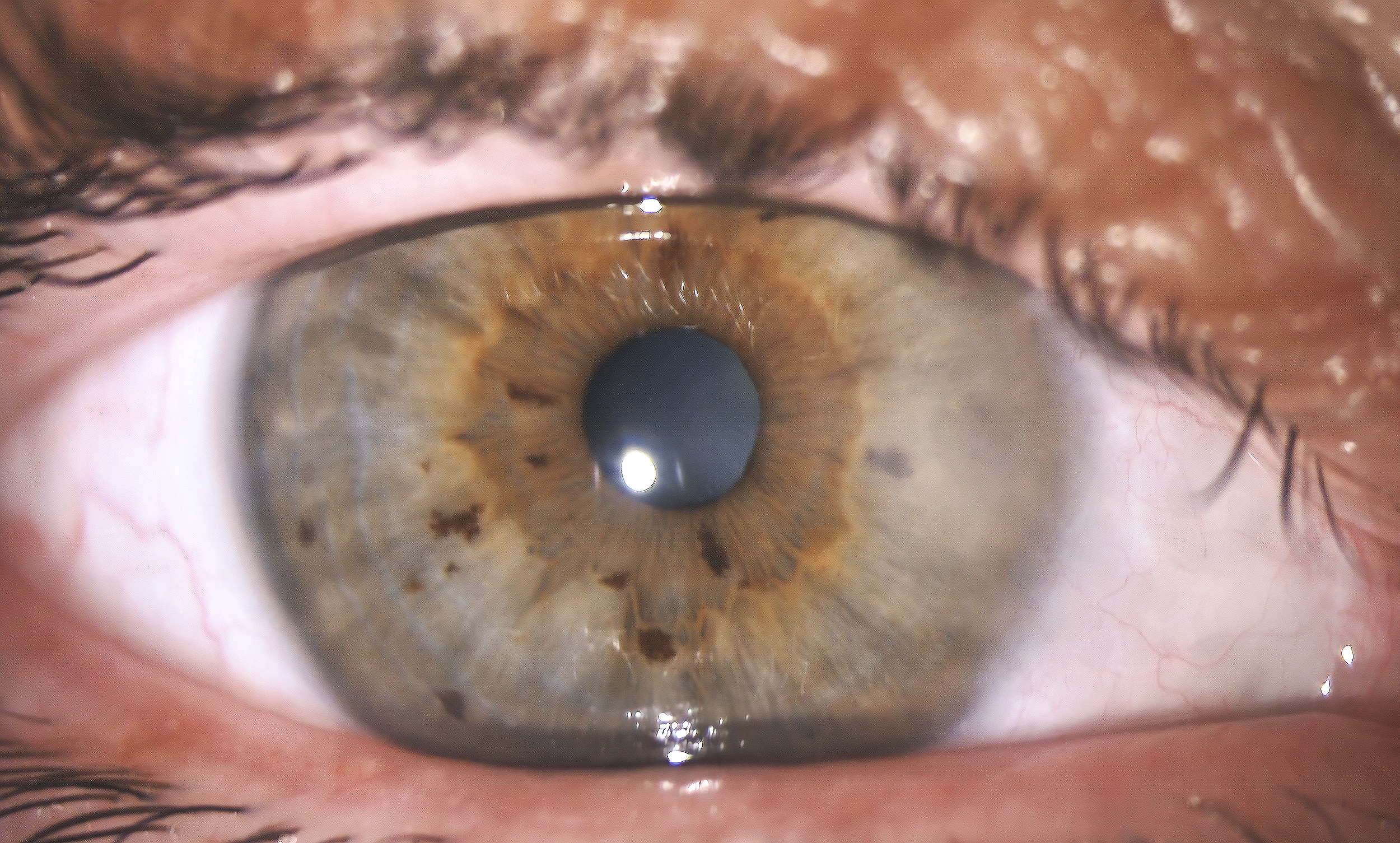 Close-up image of an eye with pristinely white conjunctiva after signature no-stitch pterygium surgery