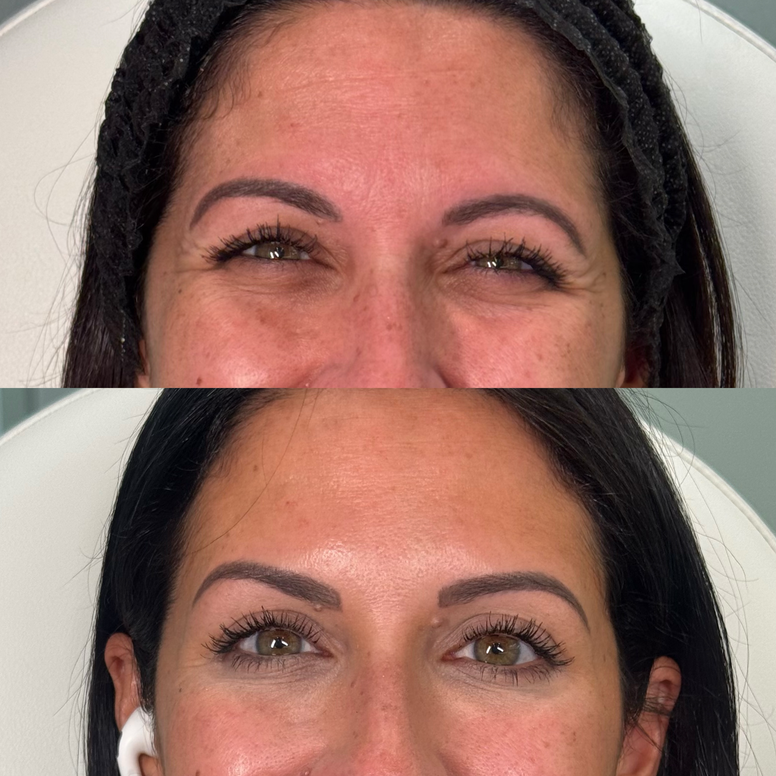Before and after cosmetic treatment showing improved skin and eyebrow appearance.