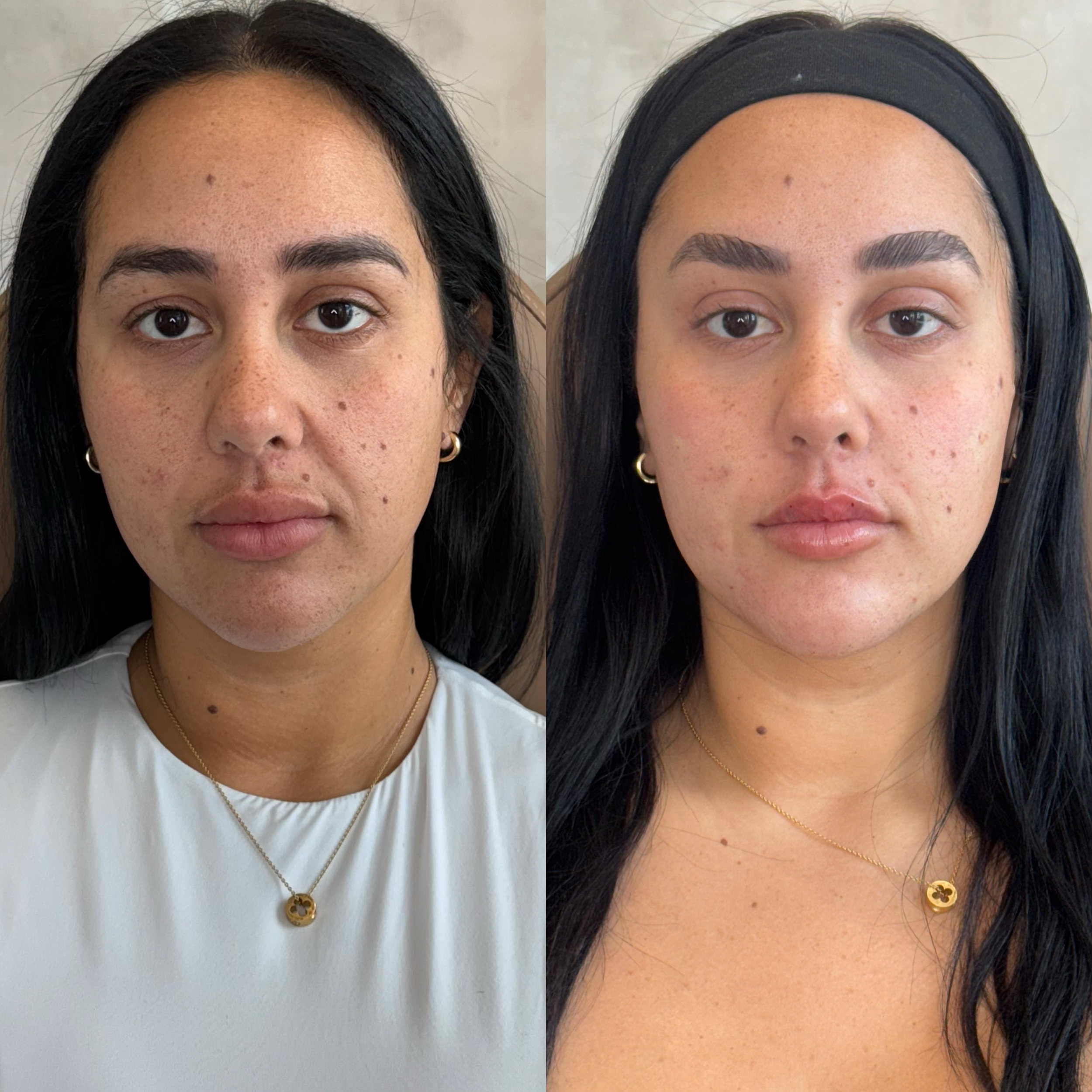  woman before and after facial balancing treatment, showing improved skin clarity and reduced blemishes.