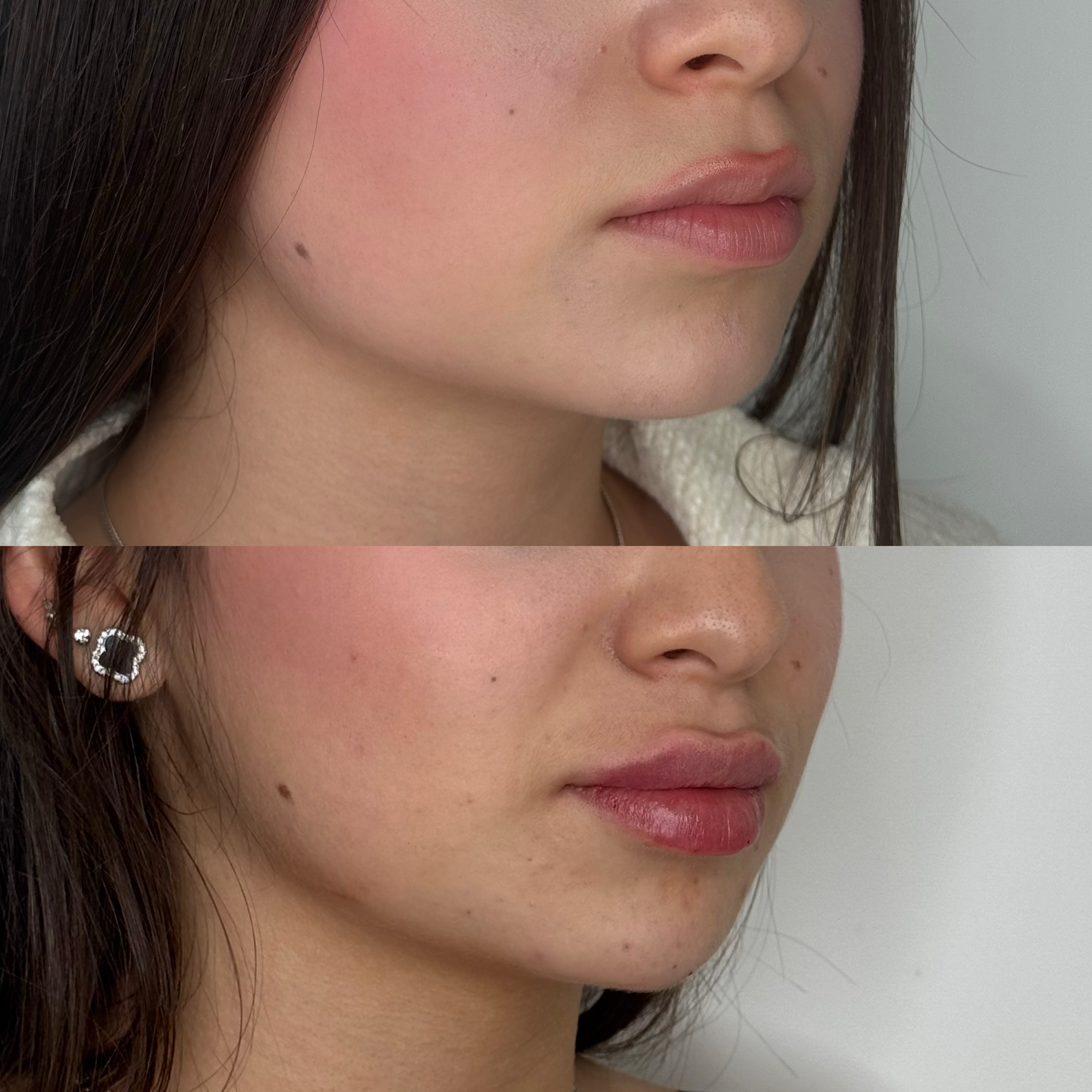 Close-up of a woman's face showing a before and after comparison of skincare or cosmetic treatment, focusing on the lower cheek and lip area.