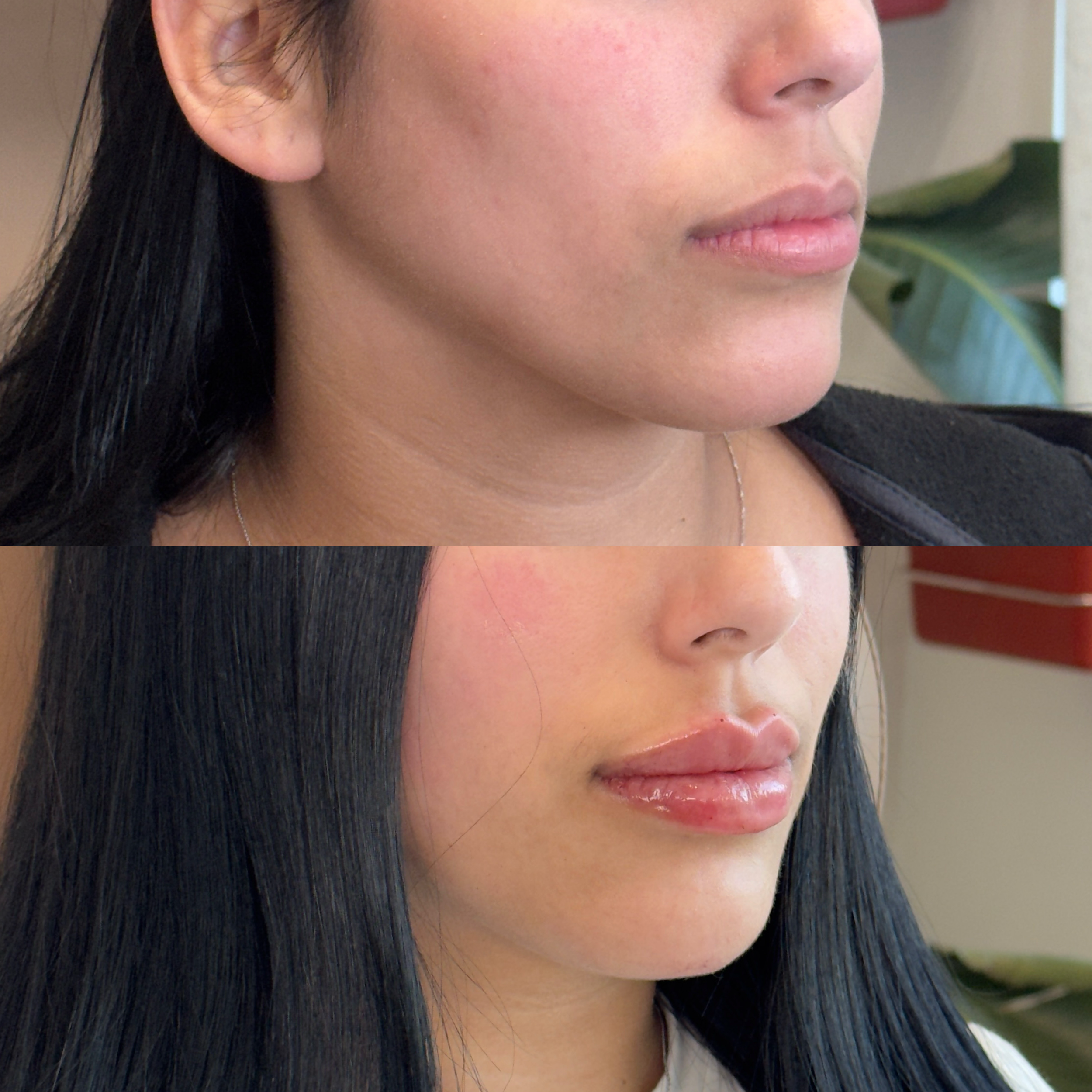 Close-up images of women's lips, before and after cosmetic lip enhancement.